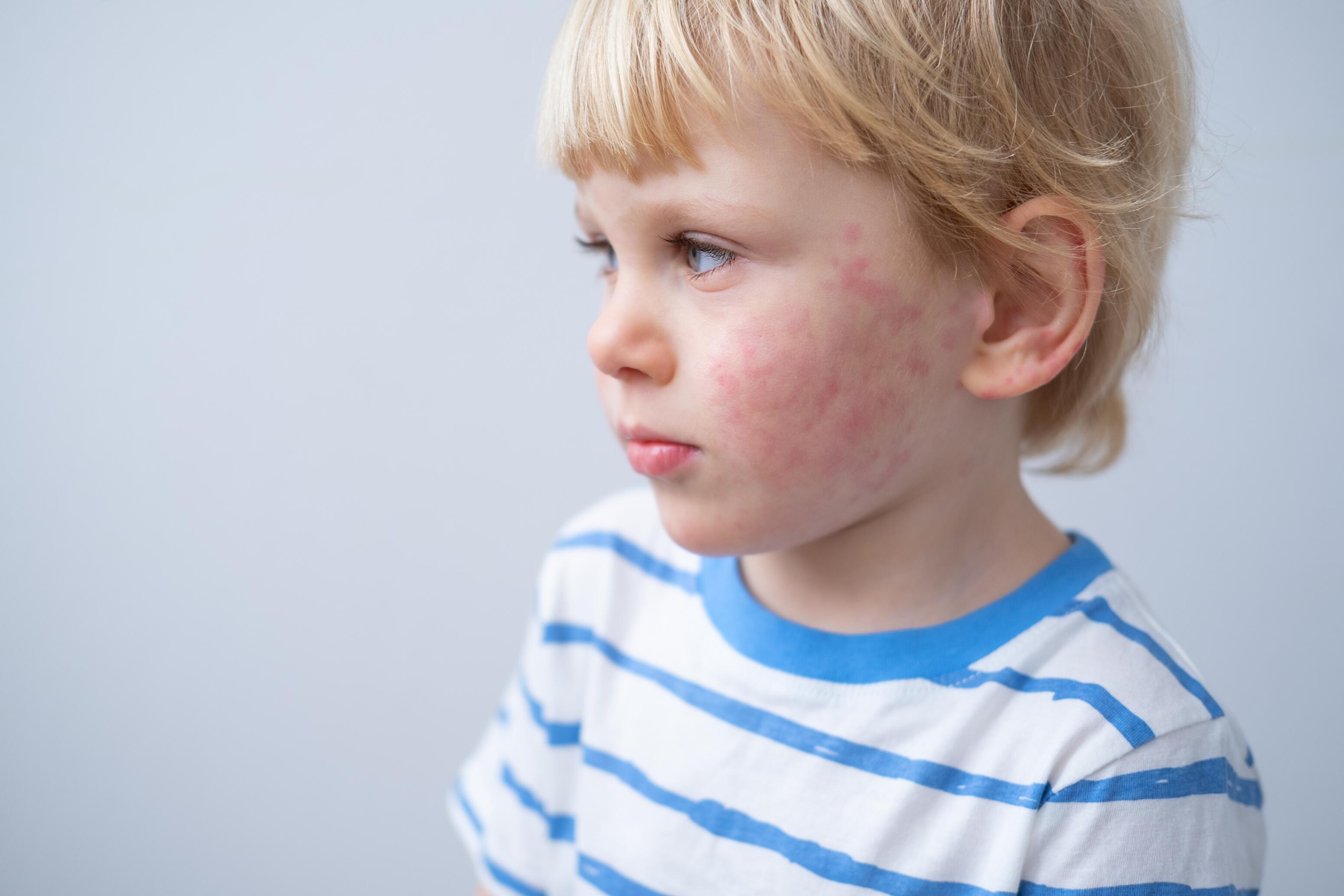 Atopic eczema or atopic dermatitis