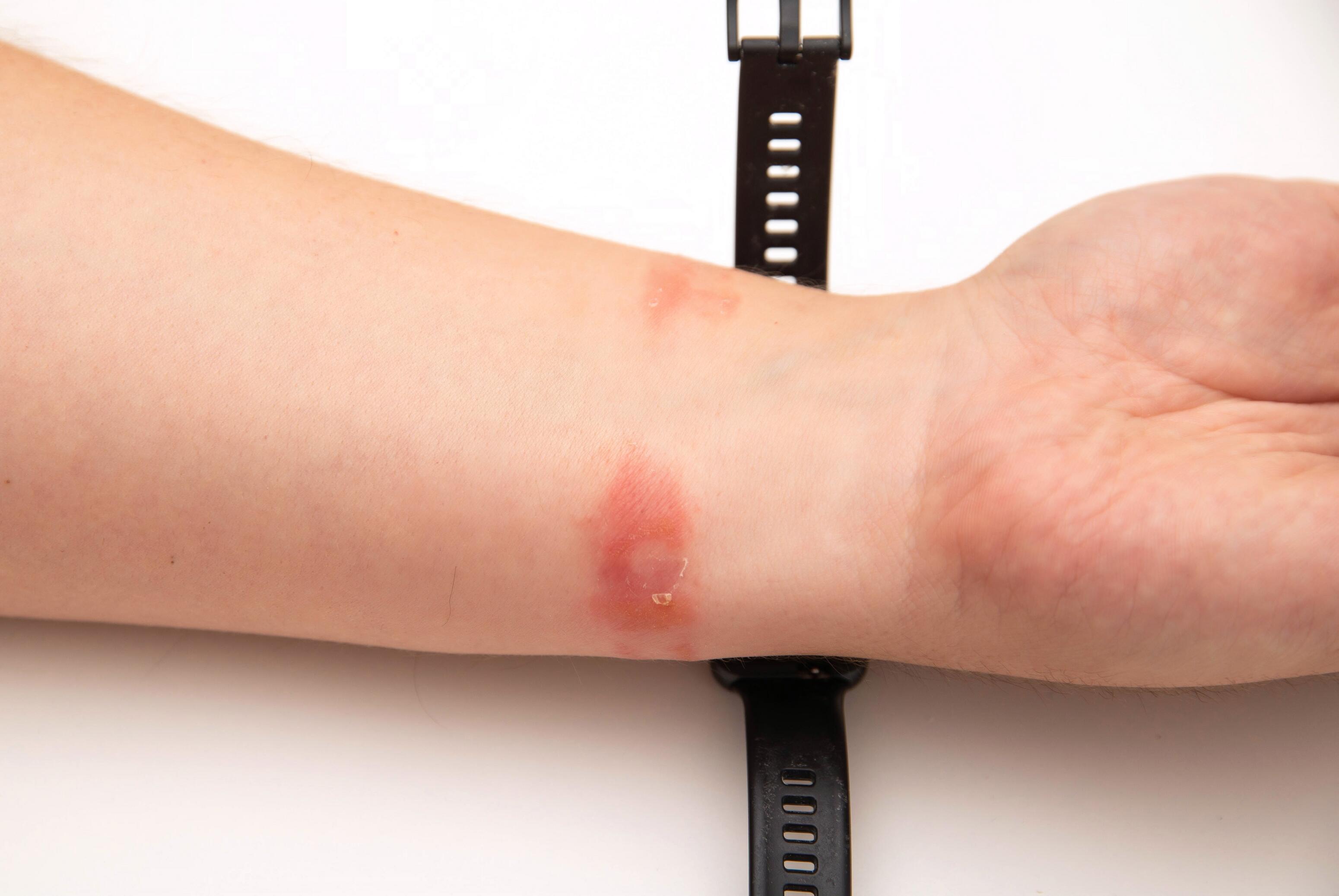 Arm with contact eczema on the wrist