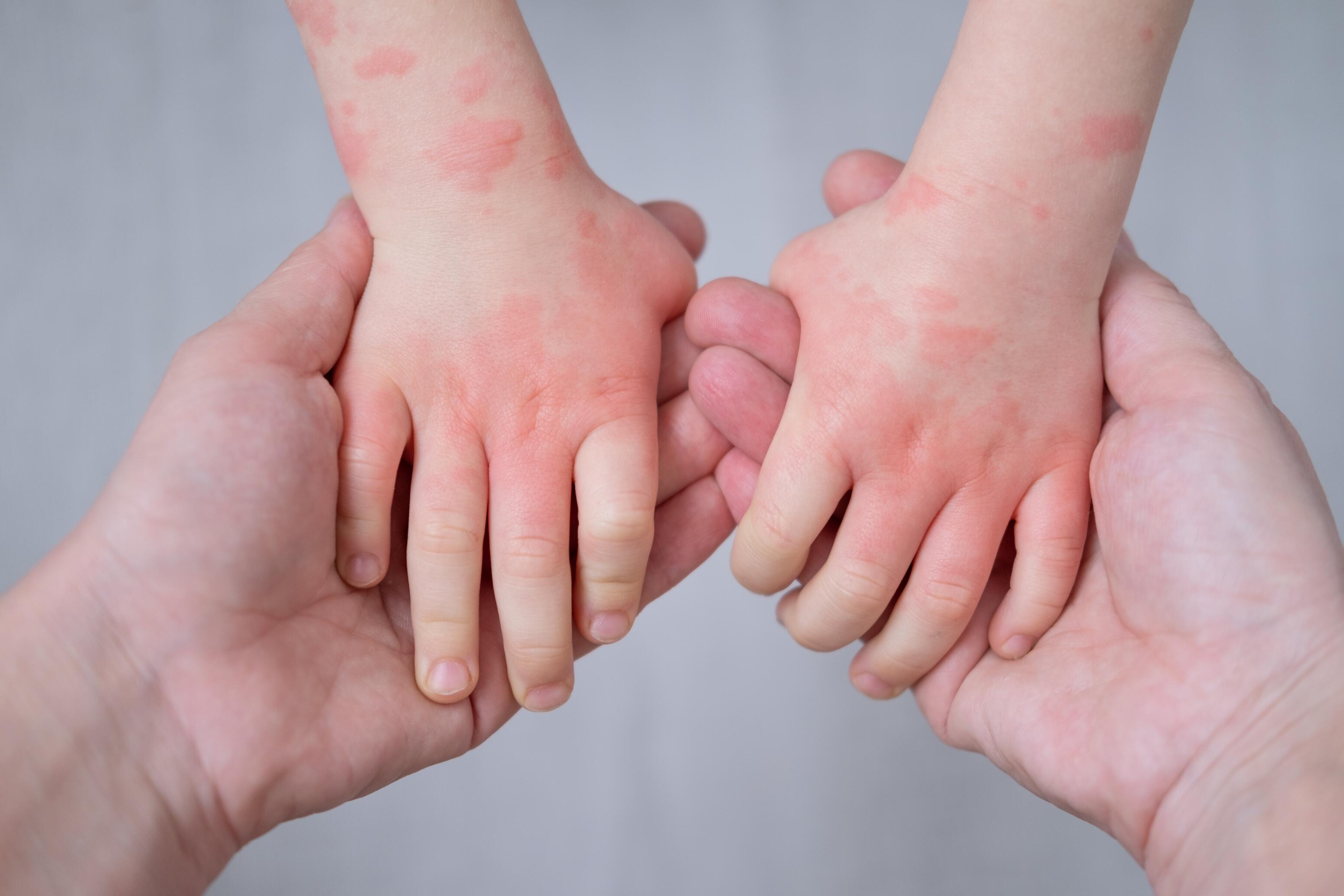Eczéma de contact irritatif ⁴ ⁵