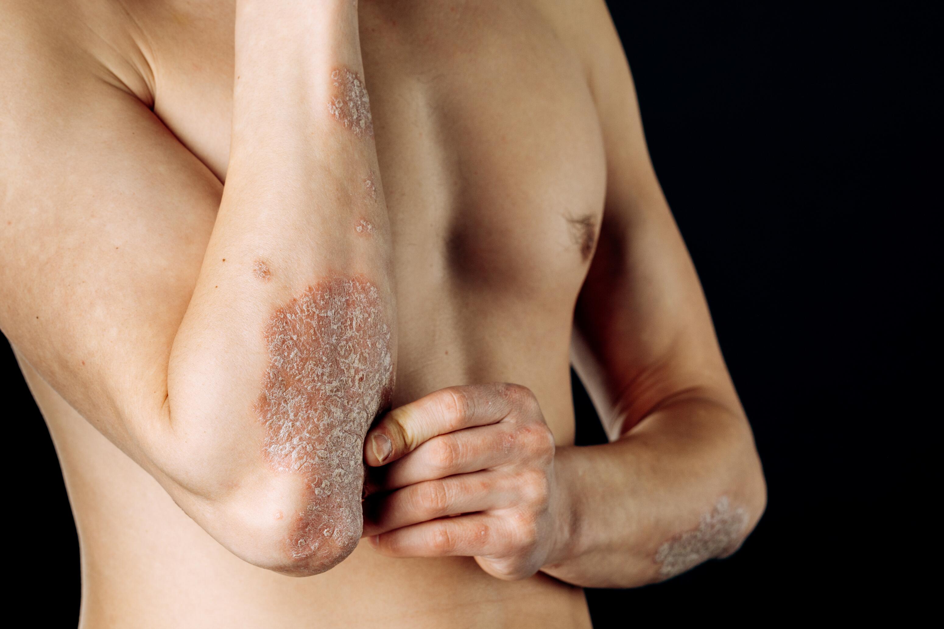 Homme avec du psoriasis sur les coudes