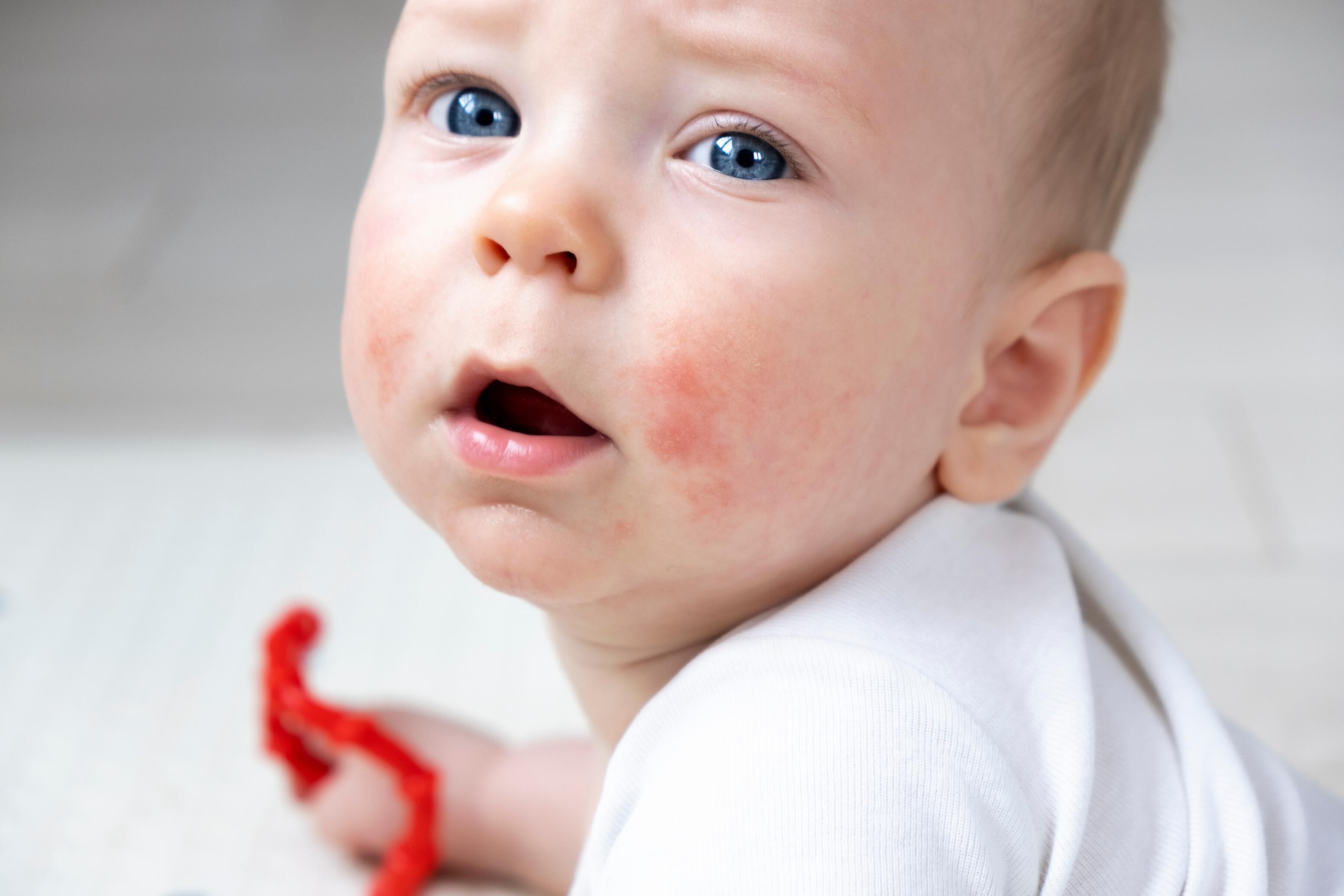 Bébé avec de la dermatite atopique sur le visage