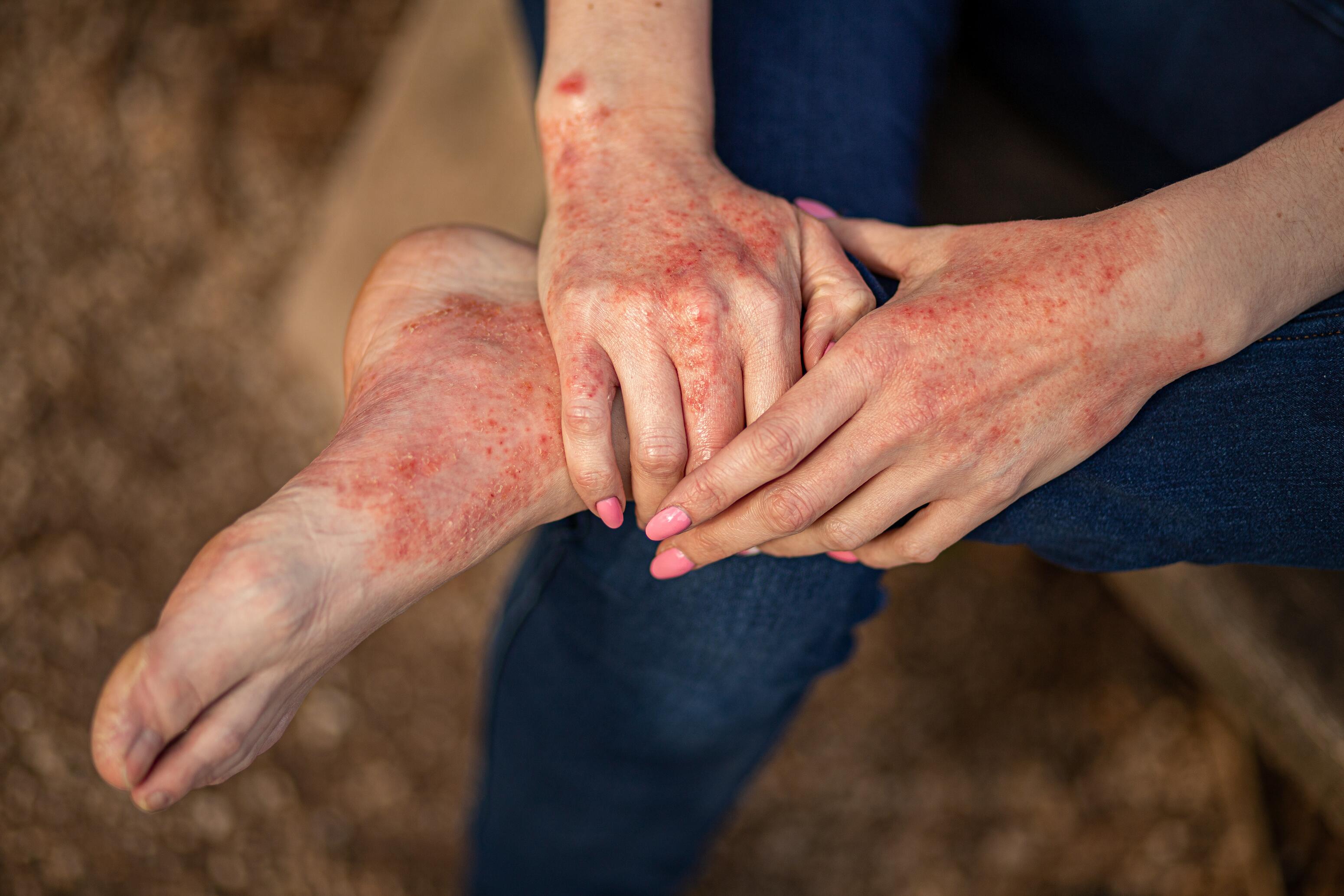 ¿El tratamiento del eczema en adultos?