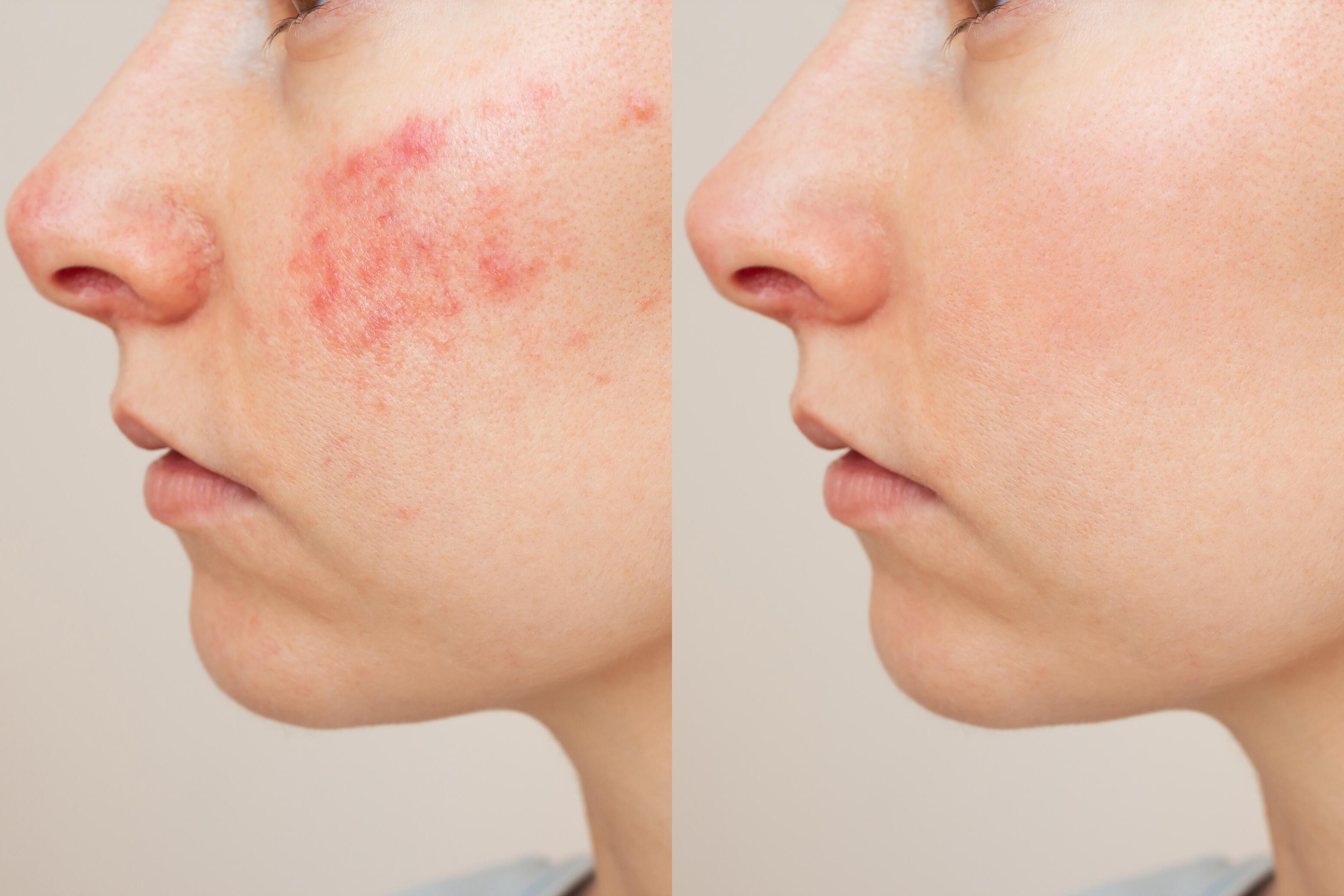 Adult before and after treatment for eczema on the cheek