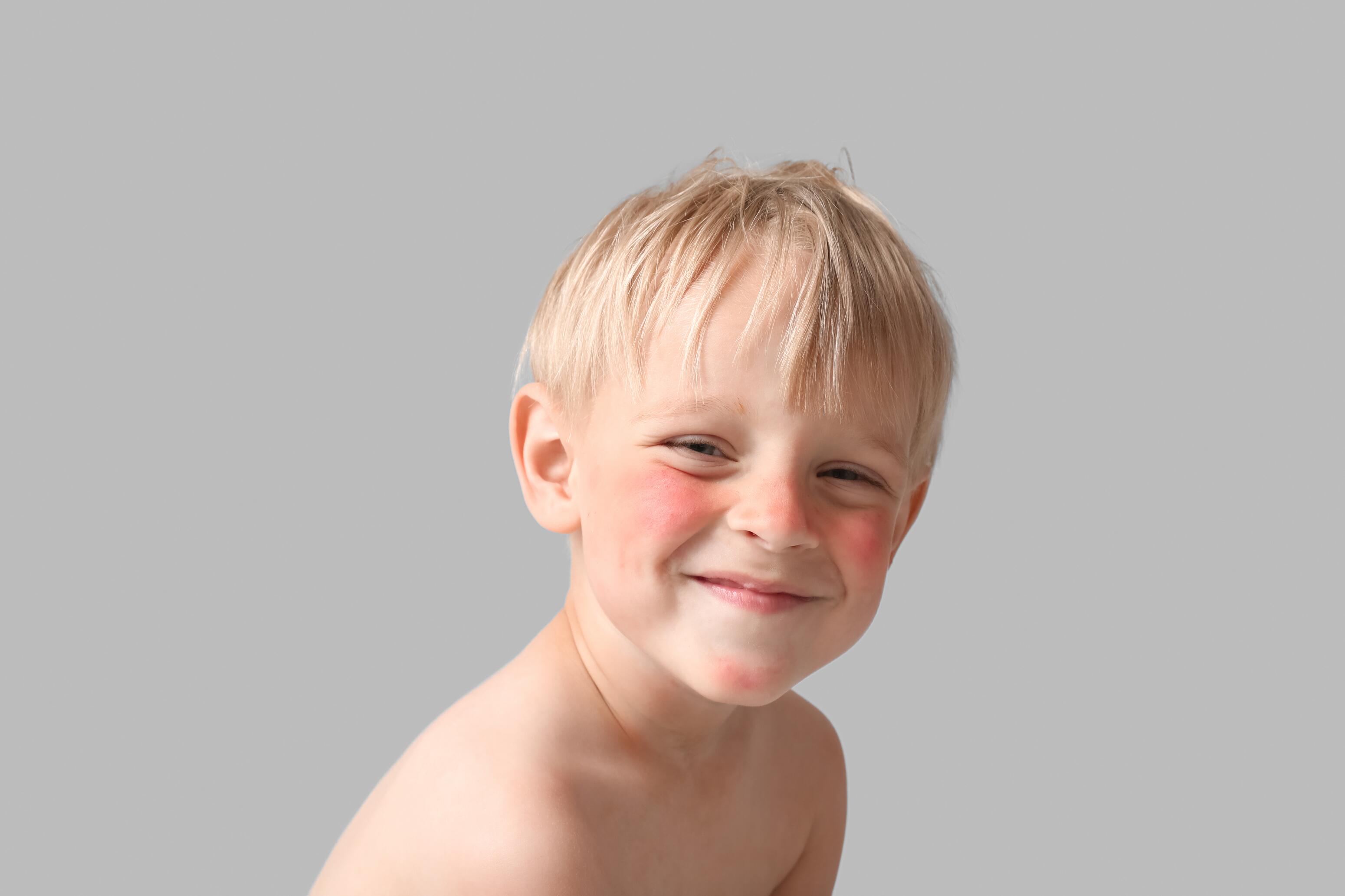 eczema-cara-dermatitis-atópica-niño