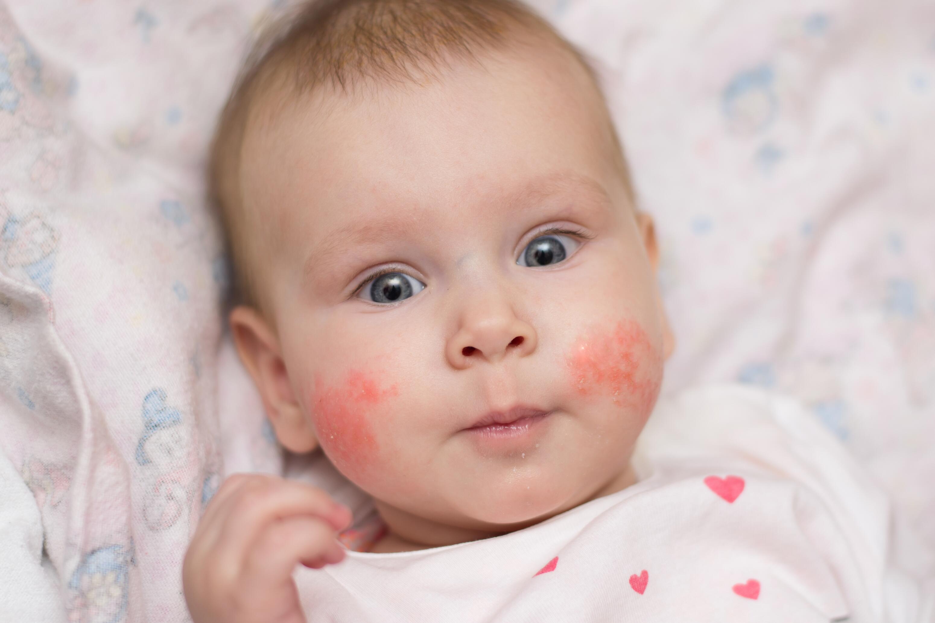 Baby with atopic eczema on the cheeks