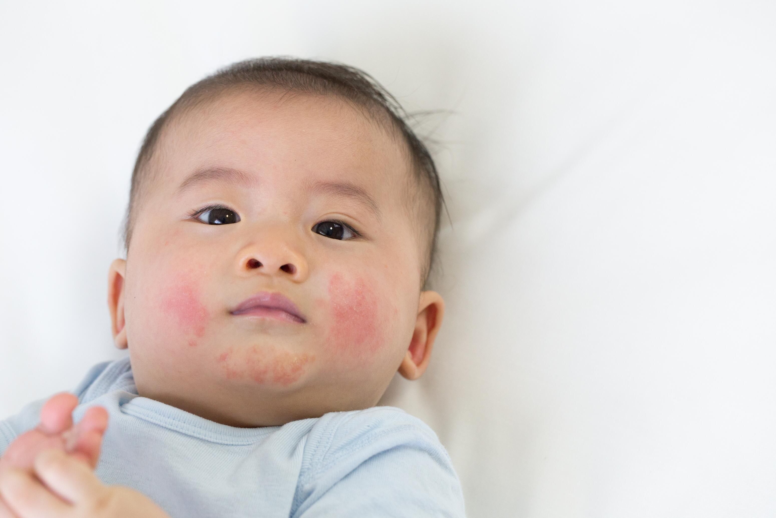 Baby with eczema patches on the face
