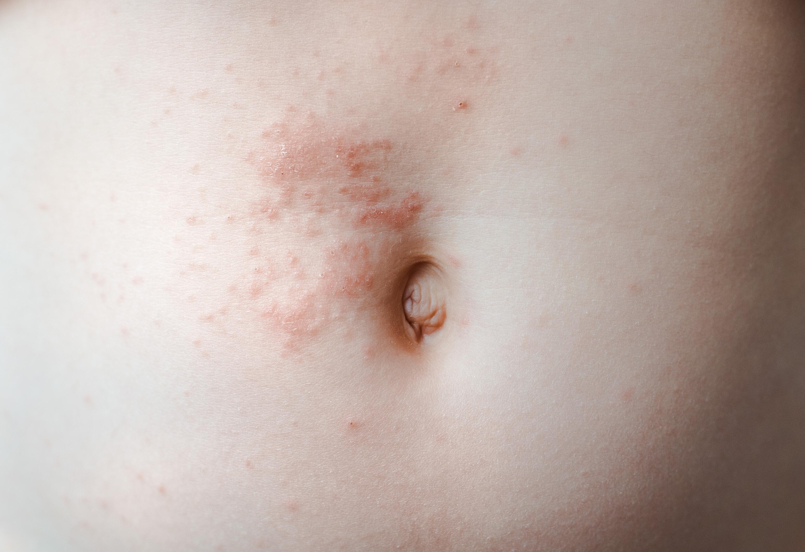 Pimples caused by scabies around the navel