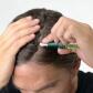 Trattamento contro la caduta dei capelli progressiva