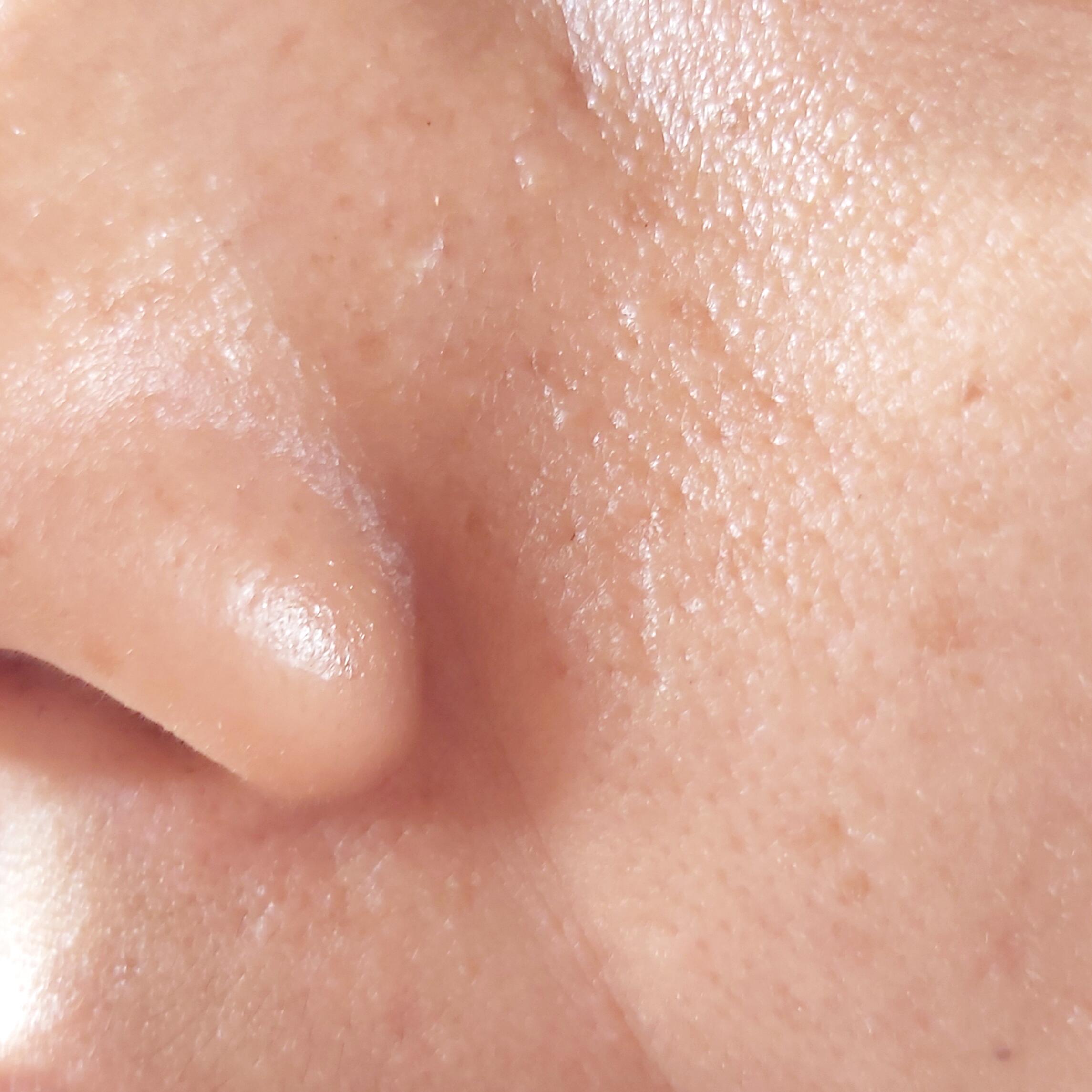 Причини за появата на мазна кожа