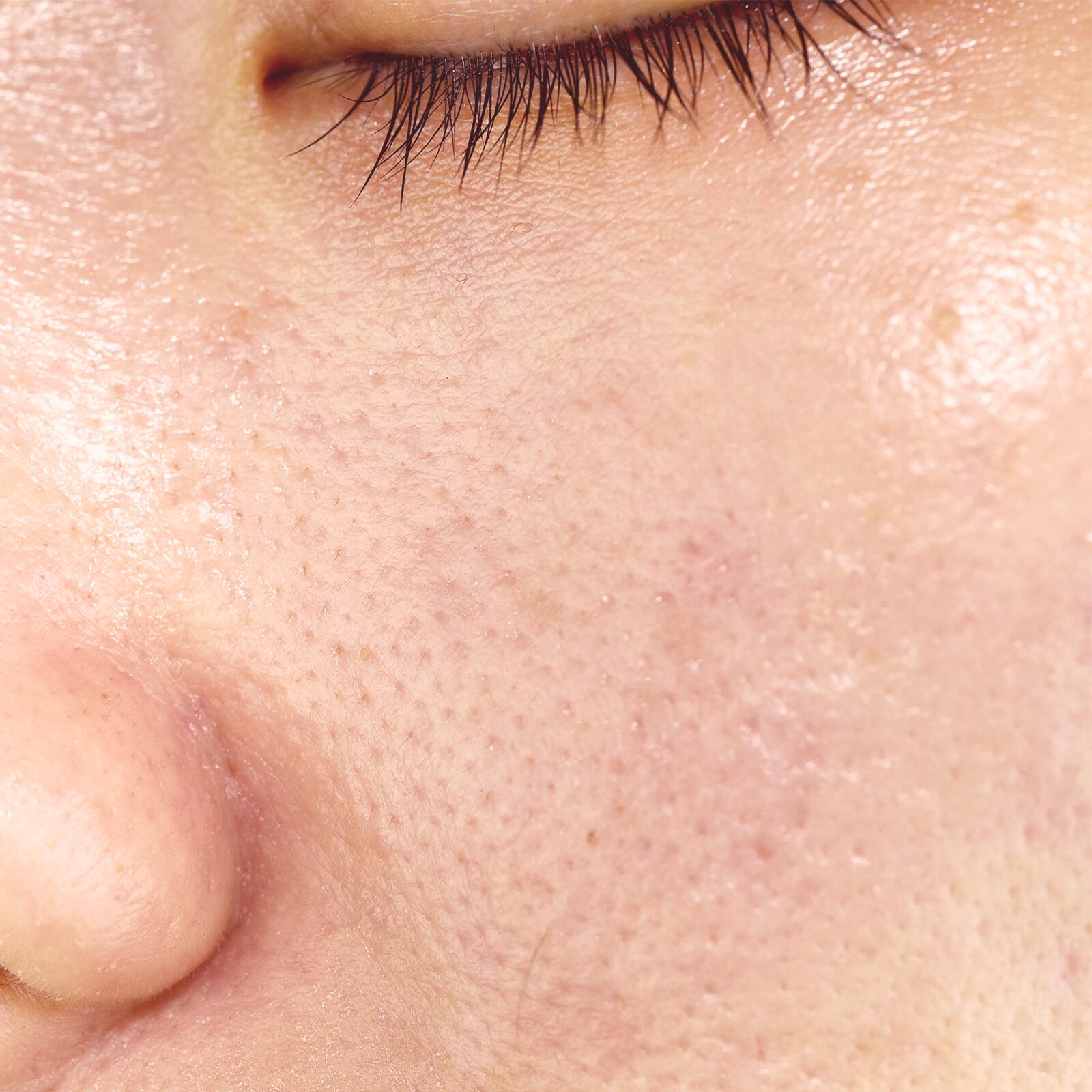 Qu'est-ce qu'une peau grasse ?