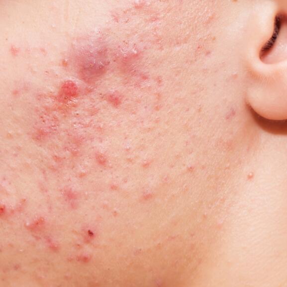 Reconnaitre l'acné inflammatoire | Avène