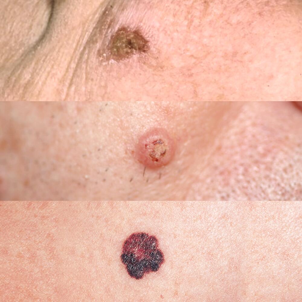 av_solaires_cancer-peau_3-types_1x1