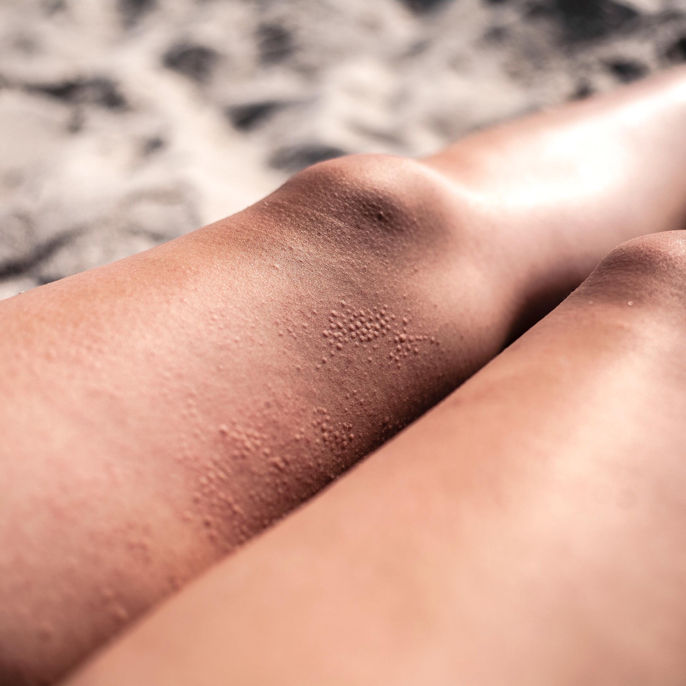 av_solaires_allergie_urticaire_1x1 473x473