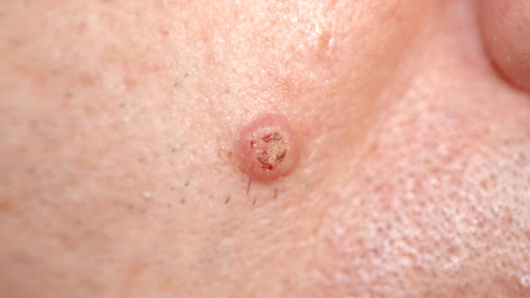 av_solaires_cancer-peau_carcinome-epidermoide_16x9