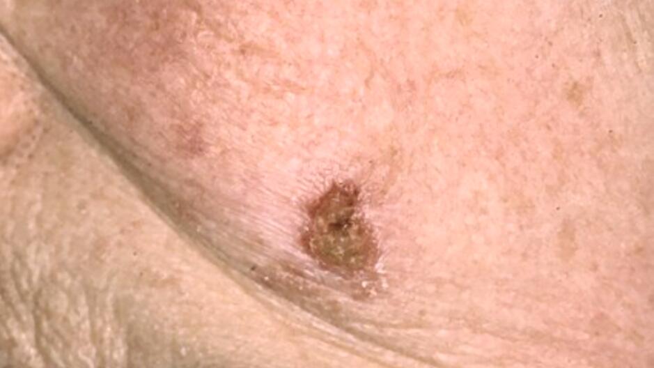 av_solaires_cancer-peau_carcinome-basocellulaire_16x9