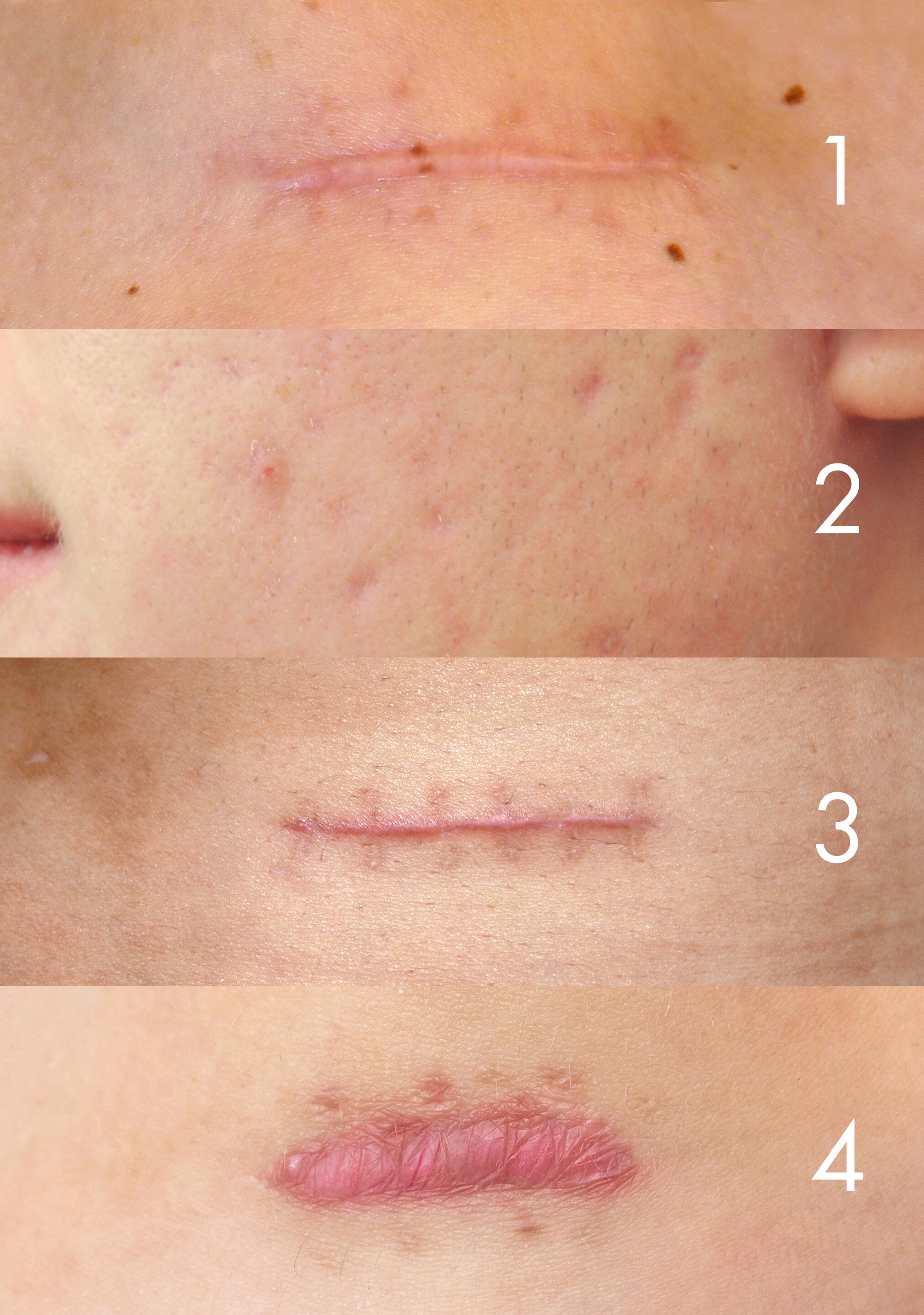 av_votre-peau_cicatrisation_types-cicatrices_4x5