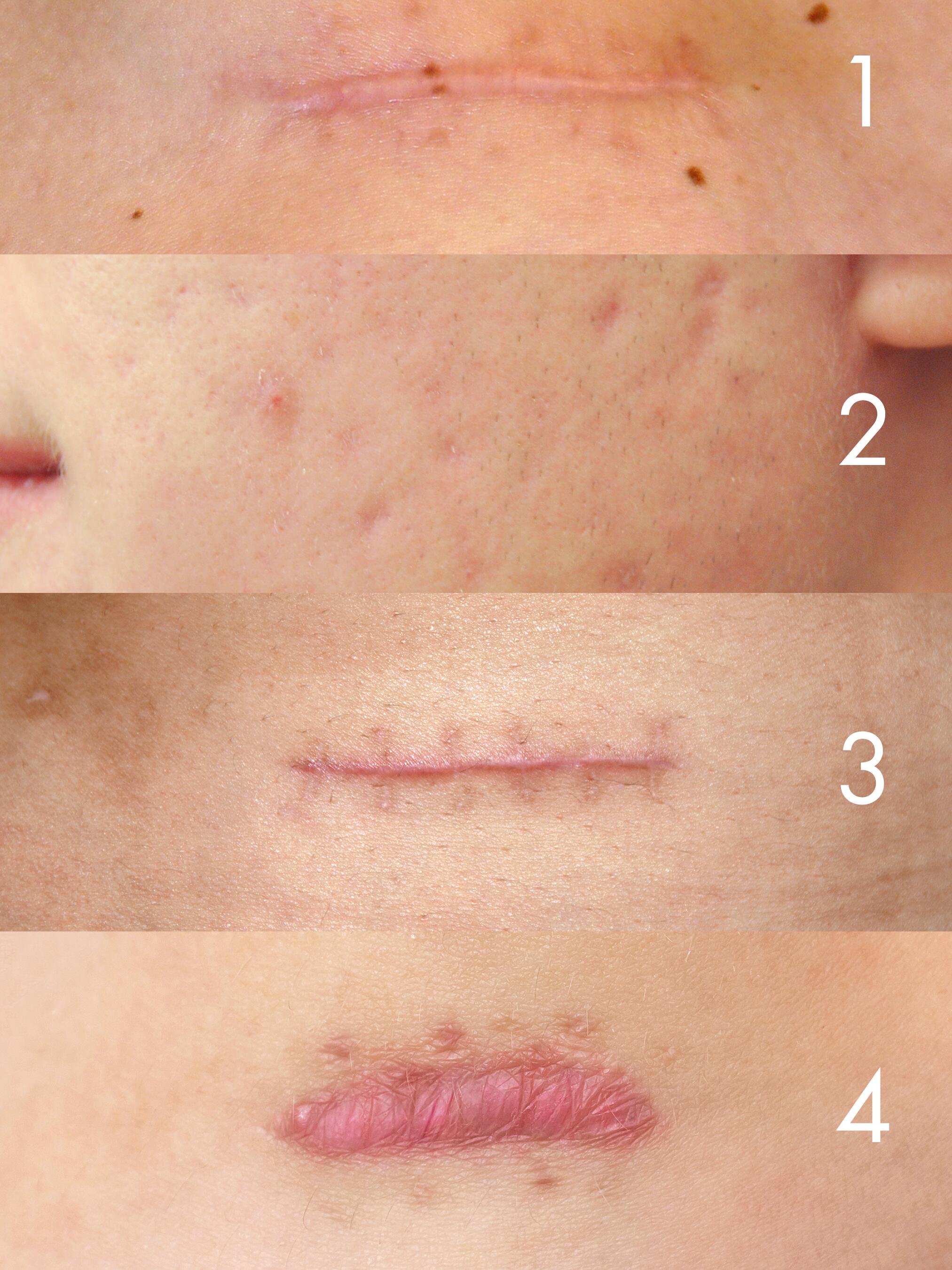 Cicatrisation de la peau : aider l'épiderme à cicatriser