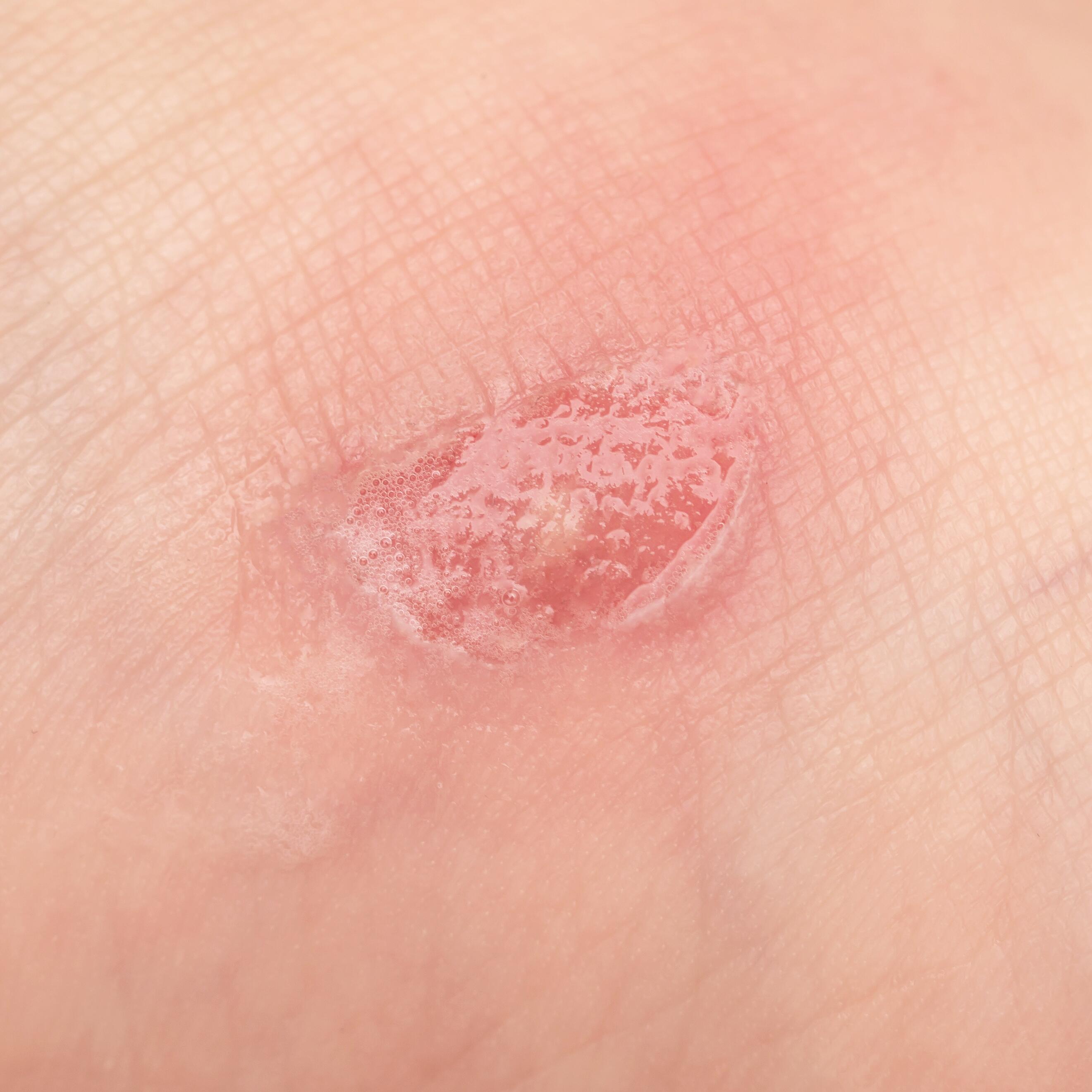 av_votre-peau_cicatrisation_plaie-infection_1x1