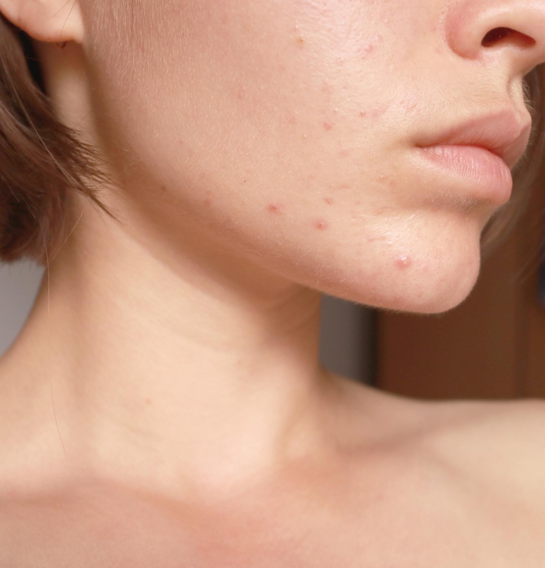 Pflege von für zu Akne neigende Haut bei Erwachsenen