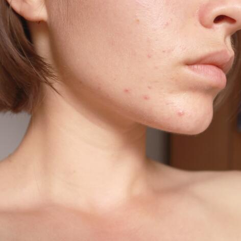 Prendre soin d'une peau acnéique chez l'adulte