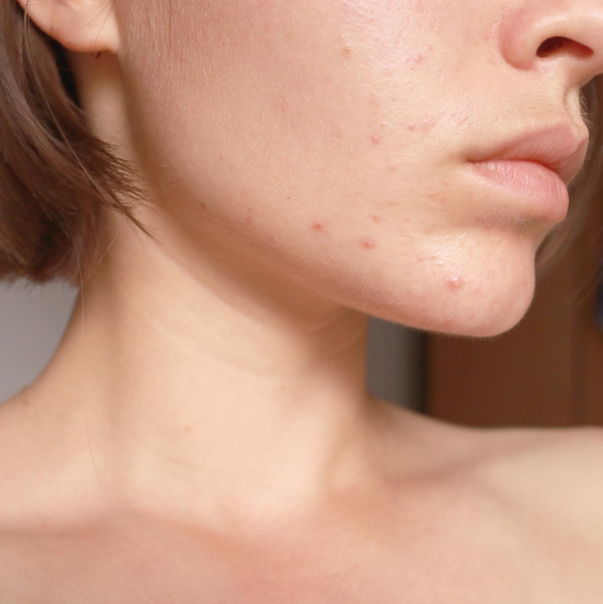 briefpapier Onrustig verbanning Verzorging van de acnegevoelige huid van volwassenen | Thermaal Water van  Avène