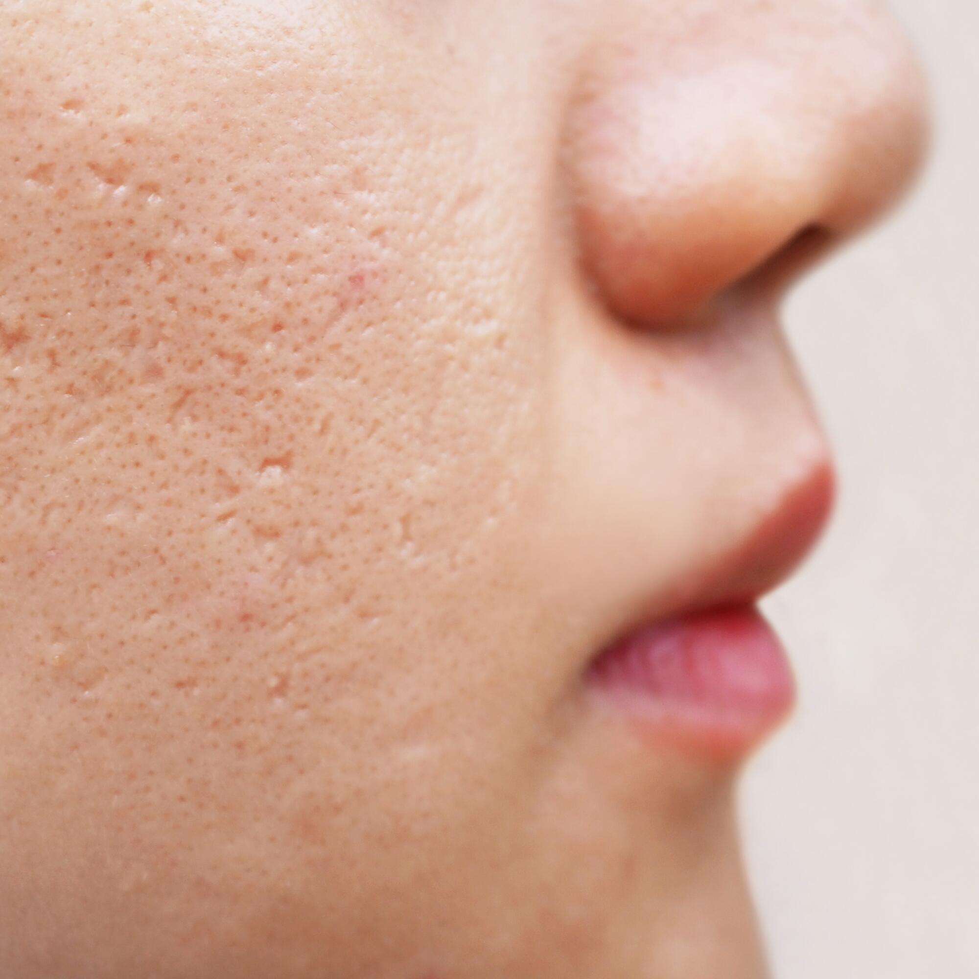 av_acne_cicatrices_1x1