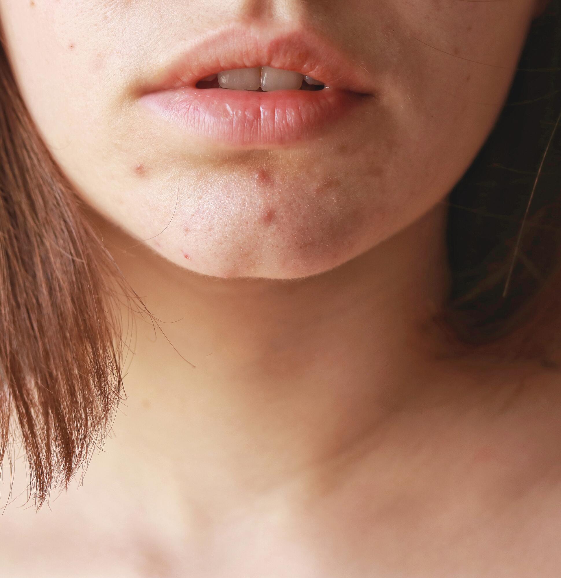 El impacto psicológico del acné en los adultos