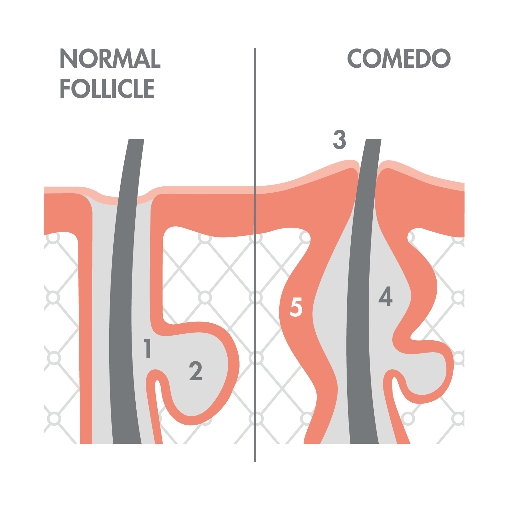av_acne_schema_acne-nodulaire_1x1 472x472