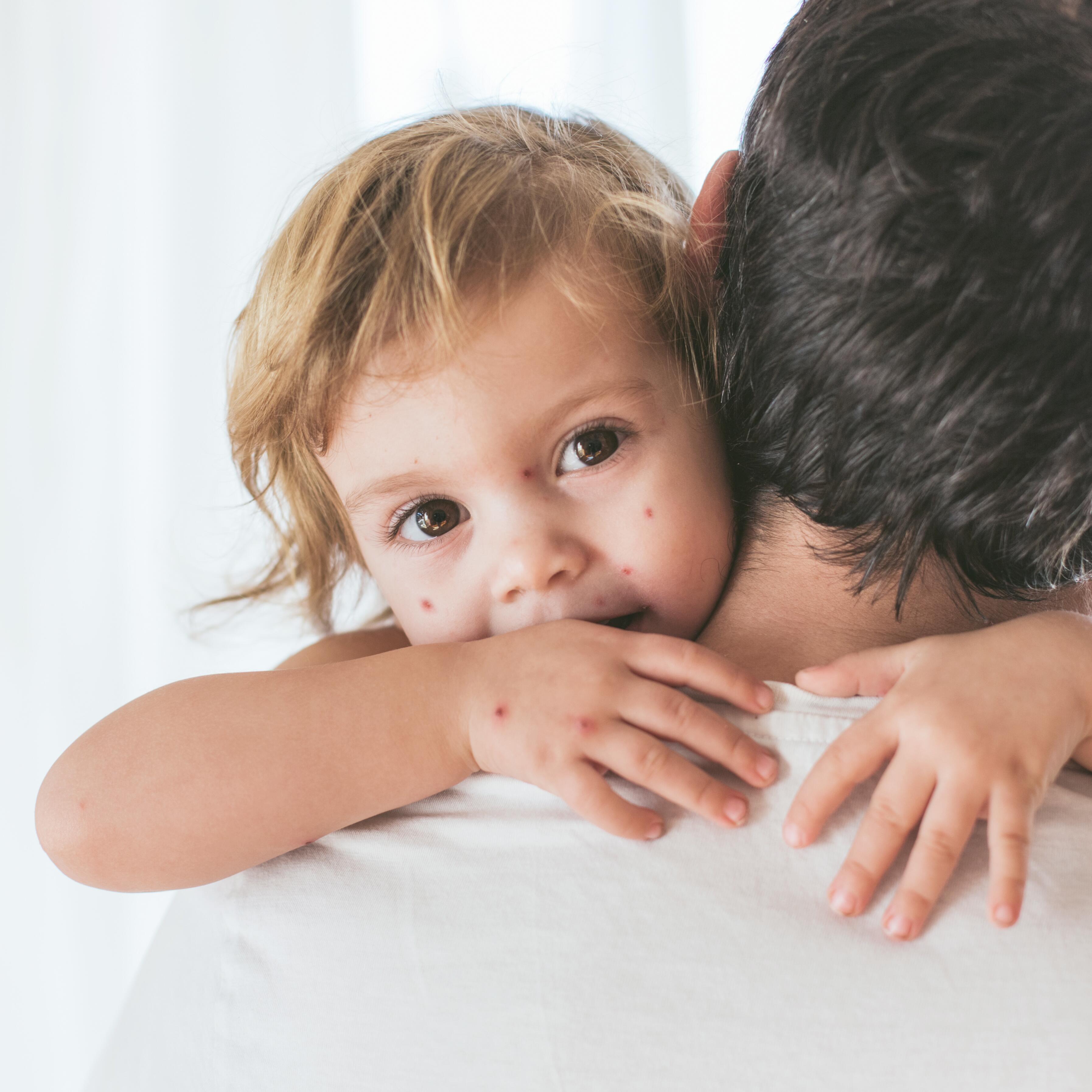 av_votre-peau_cicatrisation_varicelle_essentiel_1x1 473x473