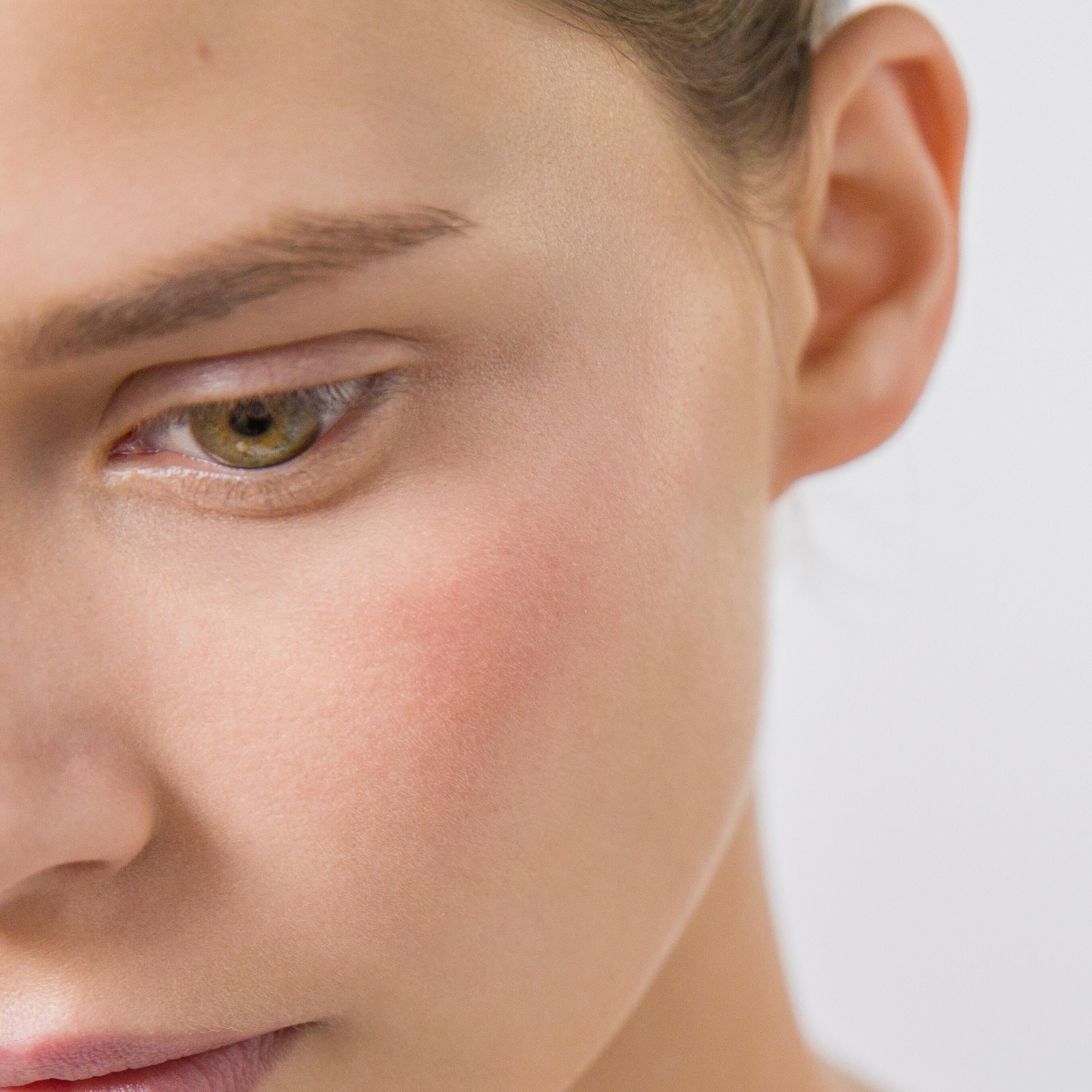 av_peaux-sensibles_crise_1x1