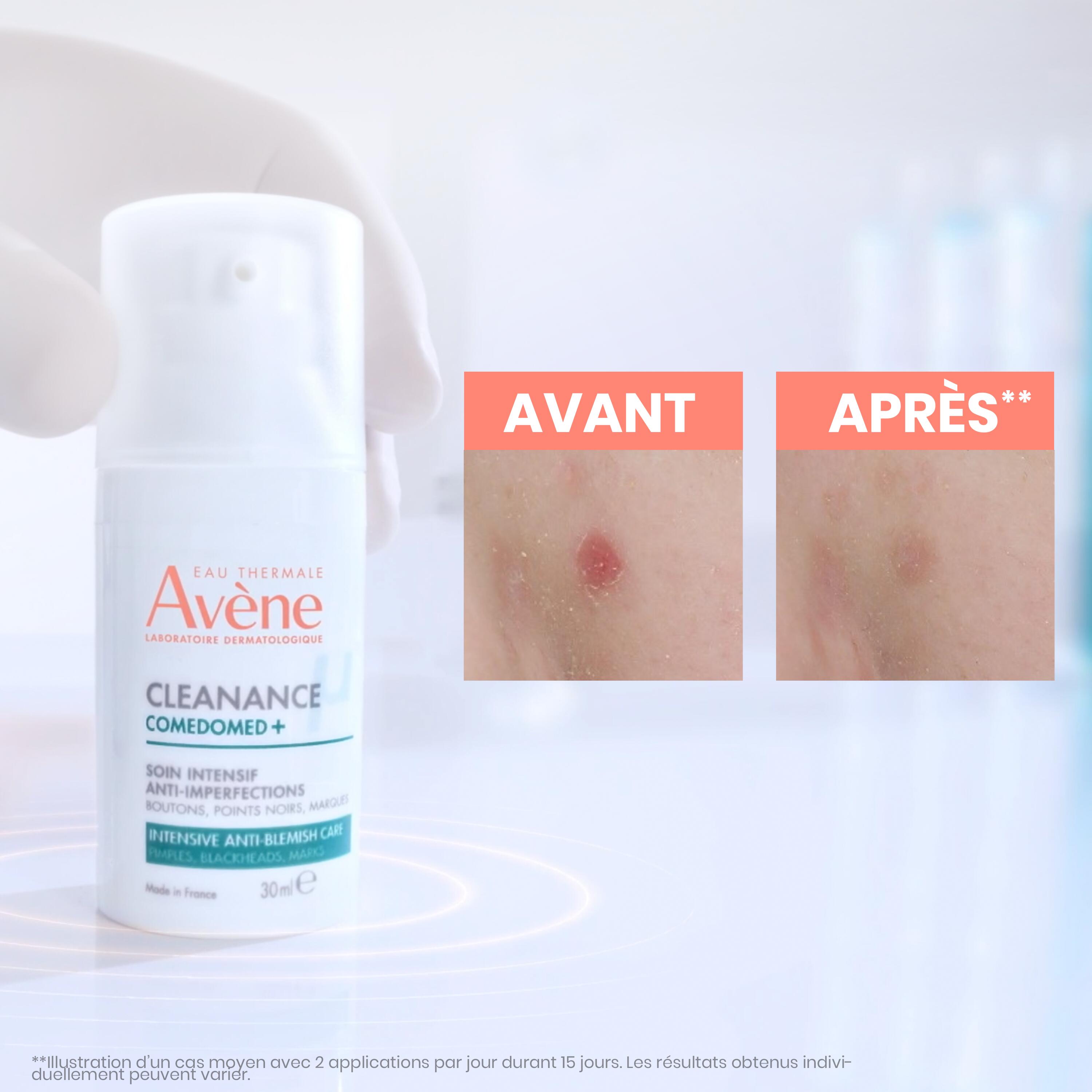Résultats Comedomed+ Soin Intensif Anti-Imperfections