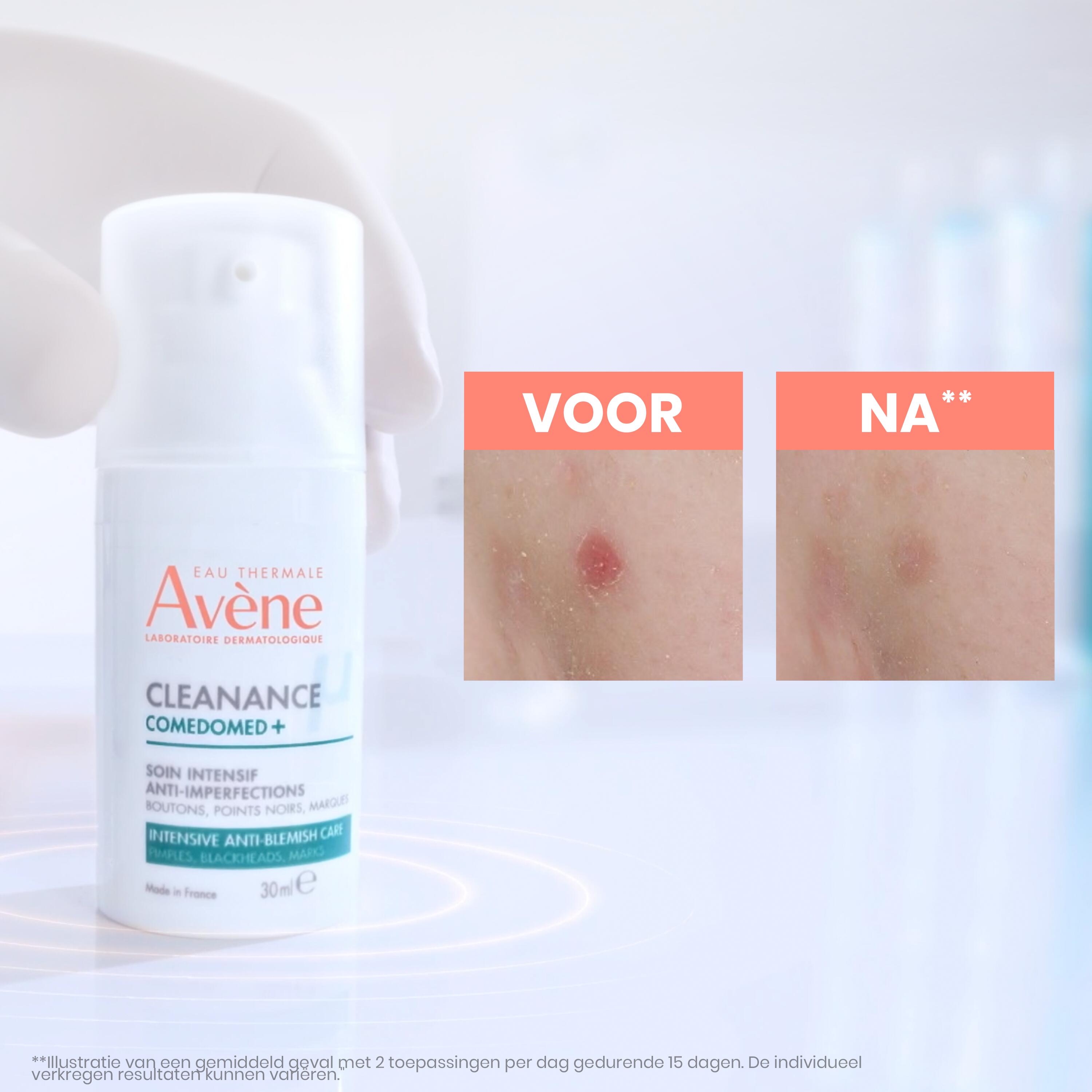 Resultaten Cleanance Comedomed+ Intensieve Verzorging tegen Oneffenheden