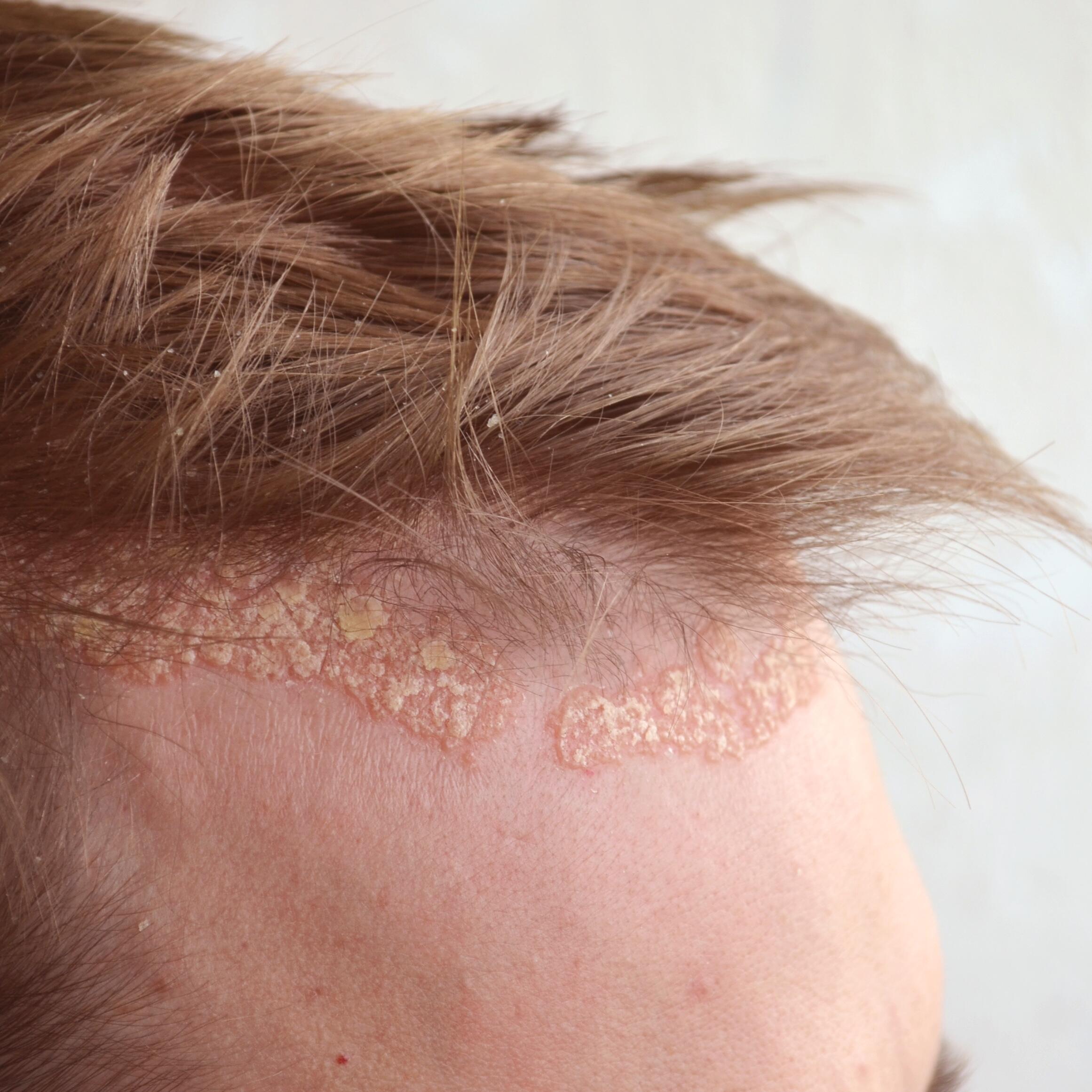 Psoriasis en el cuero cabelludo | Eau Avène