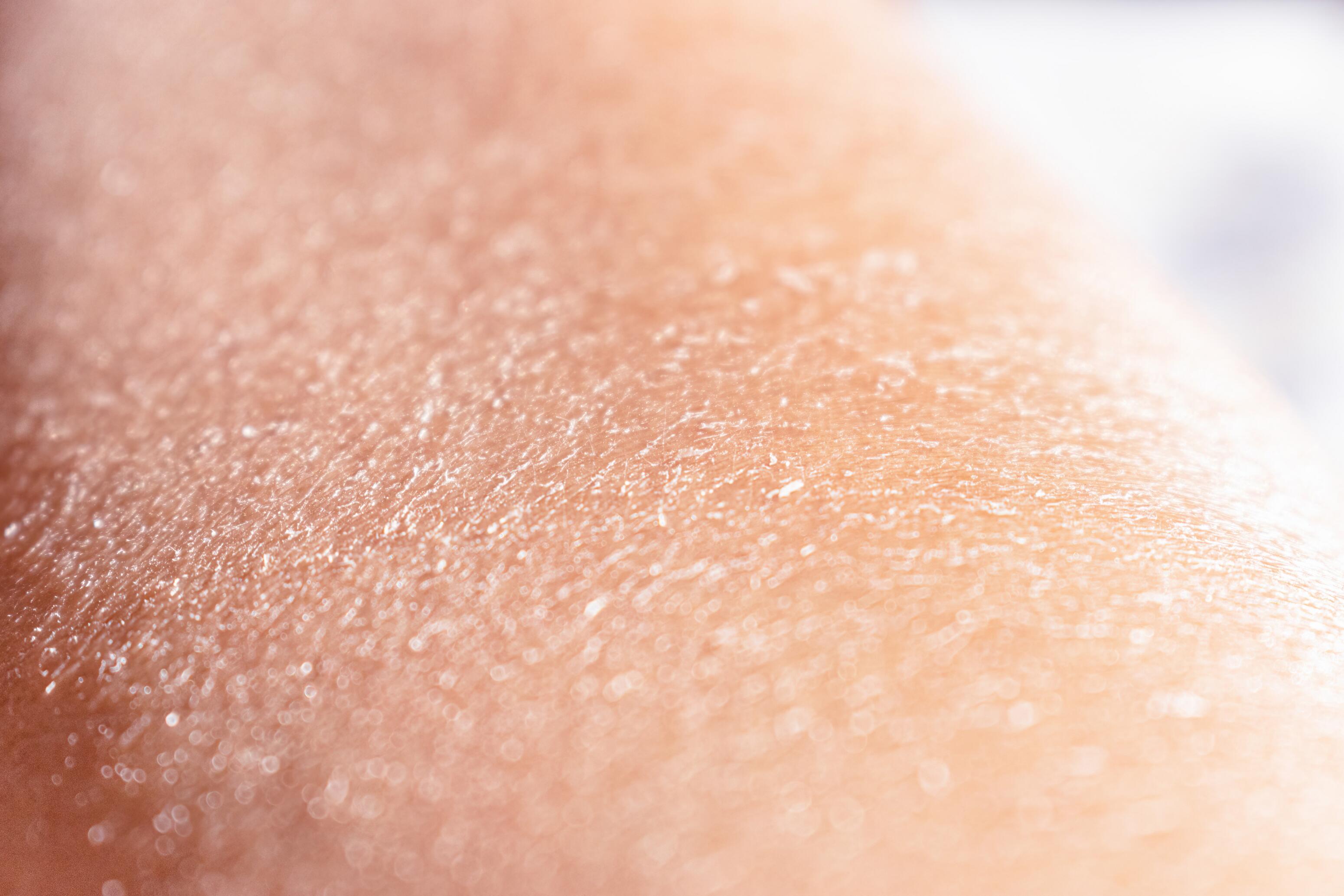 Dry skin or xerosis