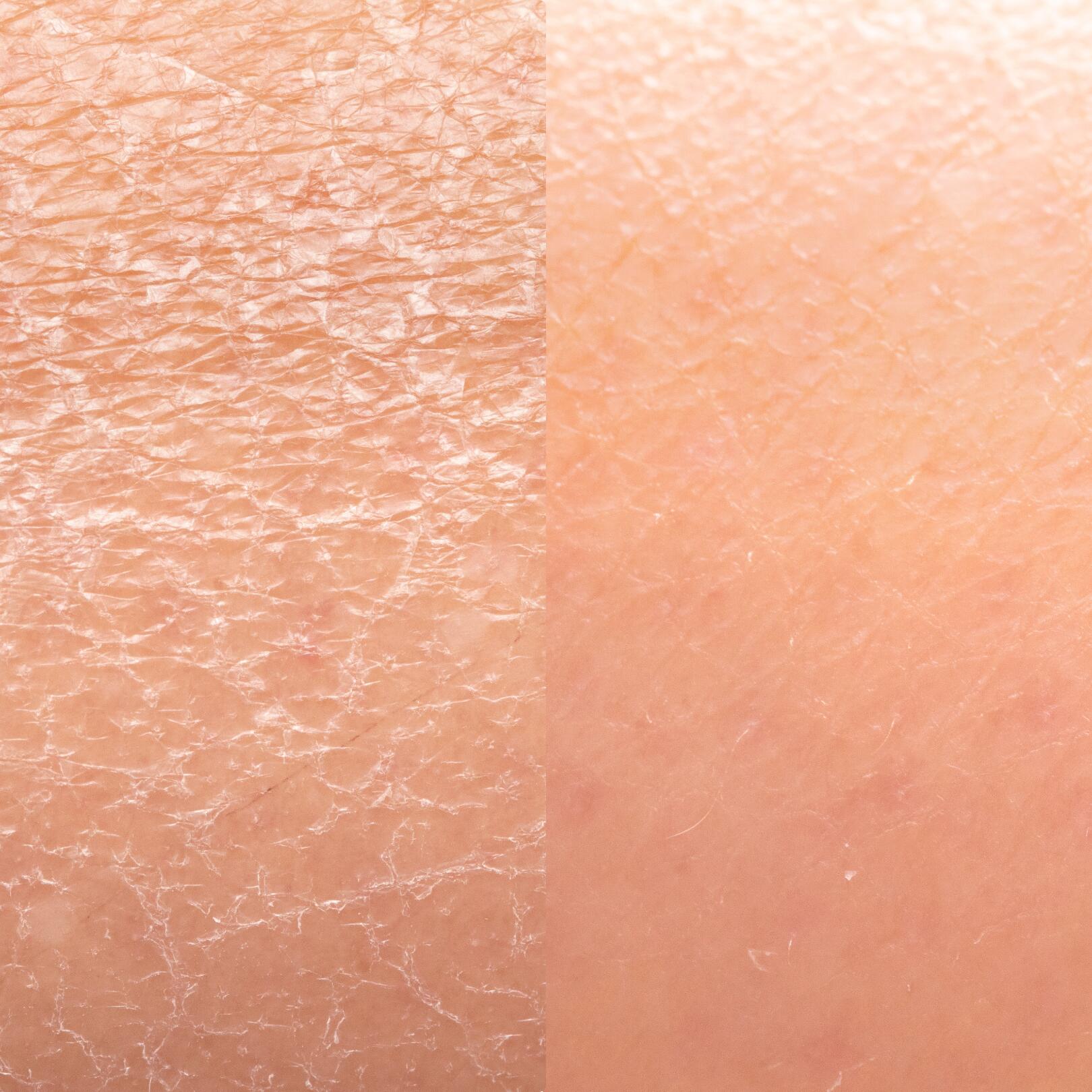 Quelles sont les caractéristiques d'une peau sèche ?