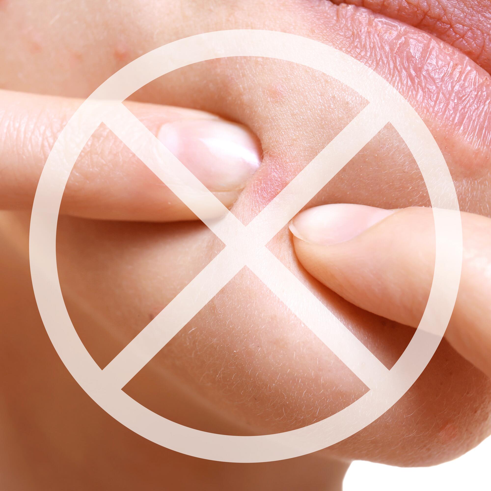 av_acne_percer-bouton_1x1