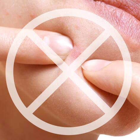 Правилните действия за успокояване на хормоналното акне