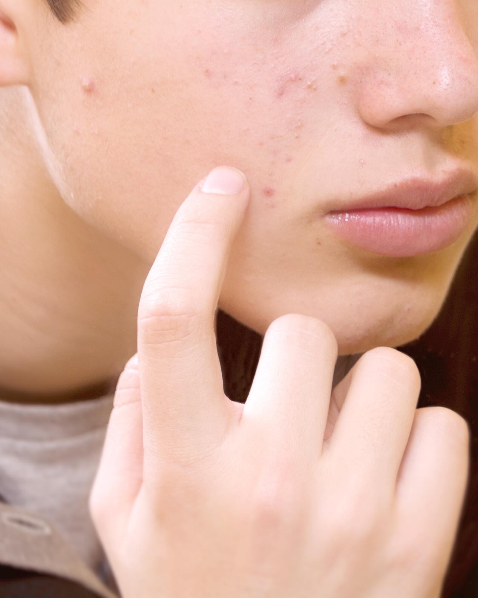 <p><a href="/a-sua-pele/pele-oleosa-com-tendencia-para-manchas-e-acne/o-que-e-pele-com-tendencia-acneica/acne-juvenil-causas-e-tratamento">Acne juvenil</a></p>

