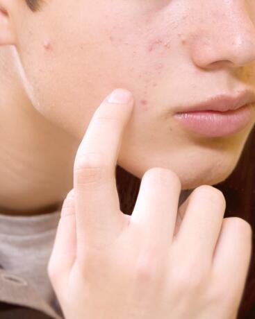 <p><a href="/en_ca/your-skin/oily-blemish-prone-and-acne-prone-skin/what-is-acne-prone-skin/teenage-acne-causes-and-treatment">Teenage acne</a></p>

