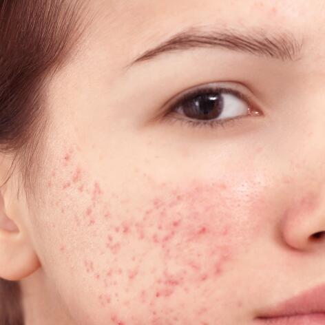 L’acné sévère