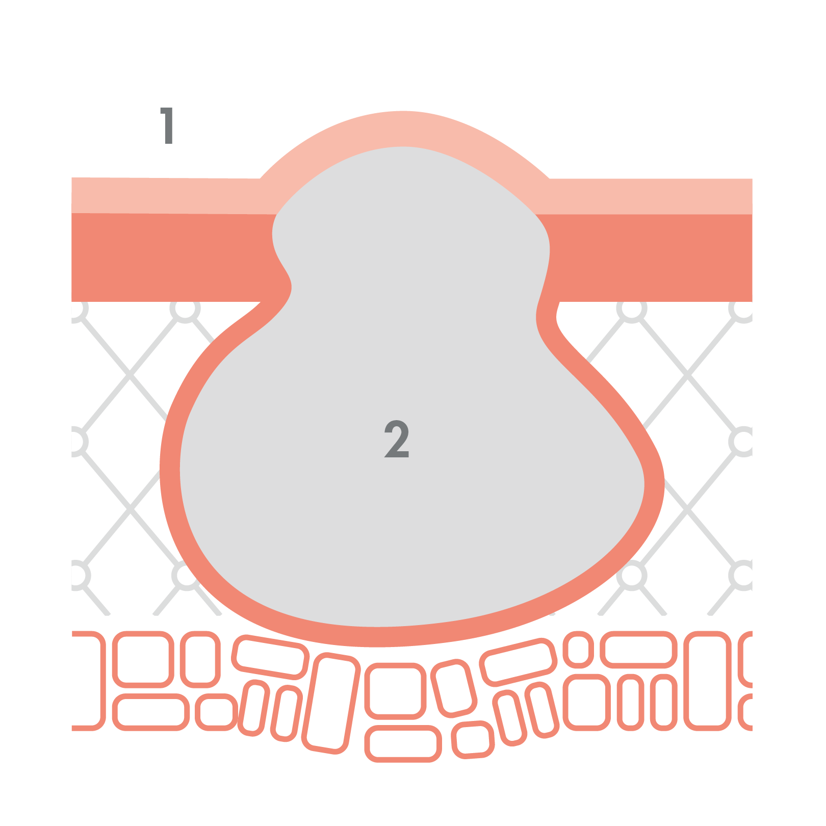 av_acne_schema_acne-nodulaire_1x1