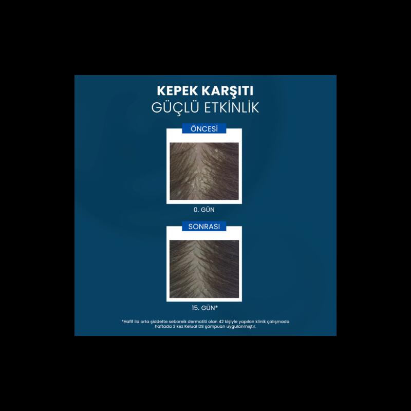 İnatçı ve Şiddetli Kepek Karşıtı Şampuan