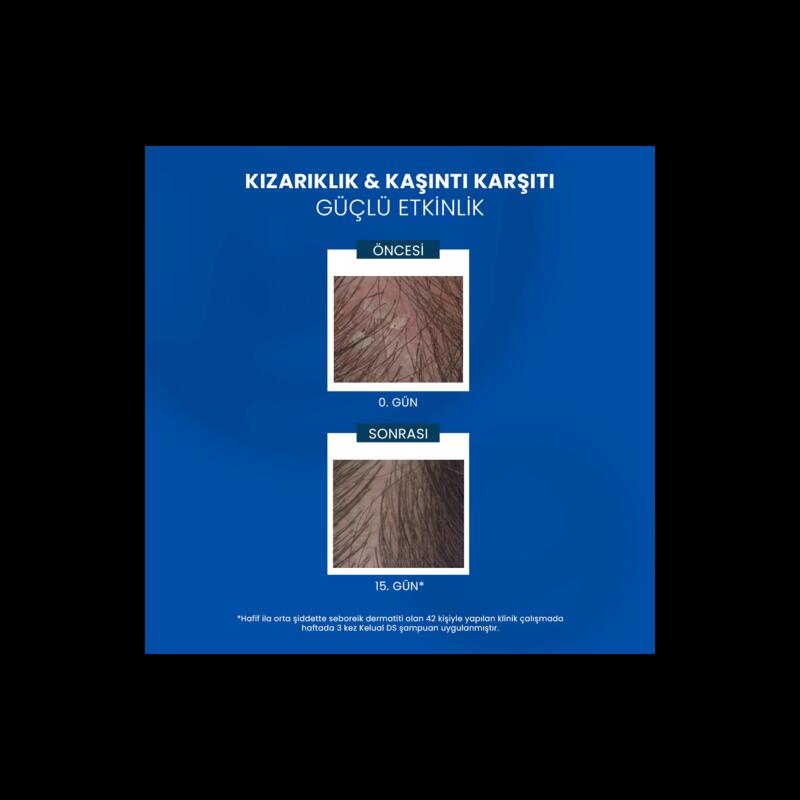 İnatçı ve Şiddetli Kepek Karşıtı Şampuan