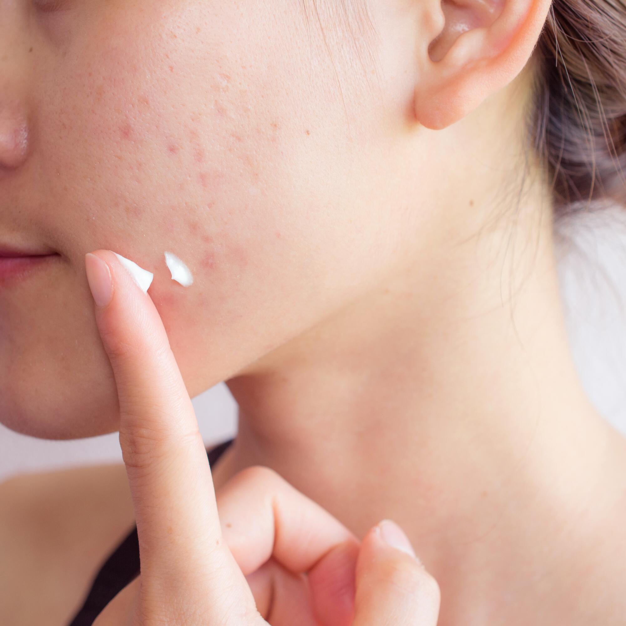 methaan afstuderen Artiest Verzorging van de huid met neiging tot acne | Eau Thermale Avène