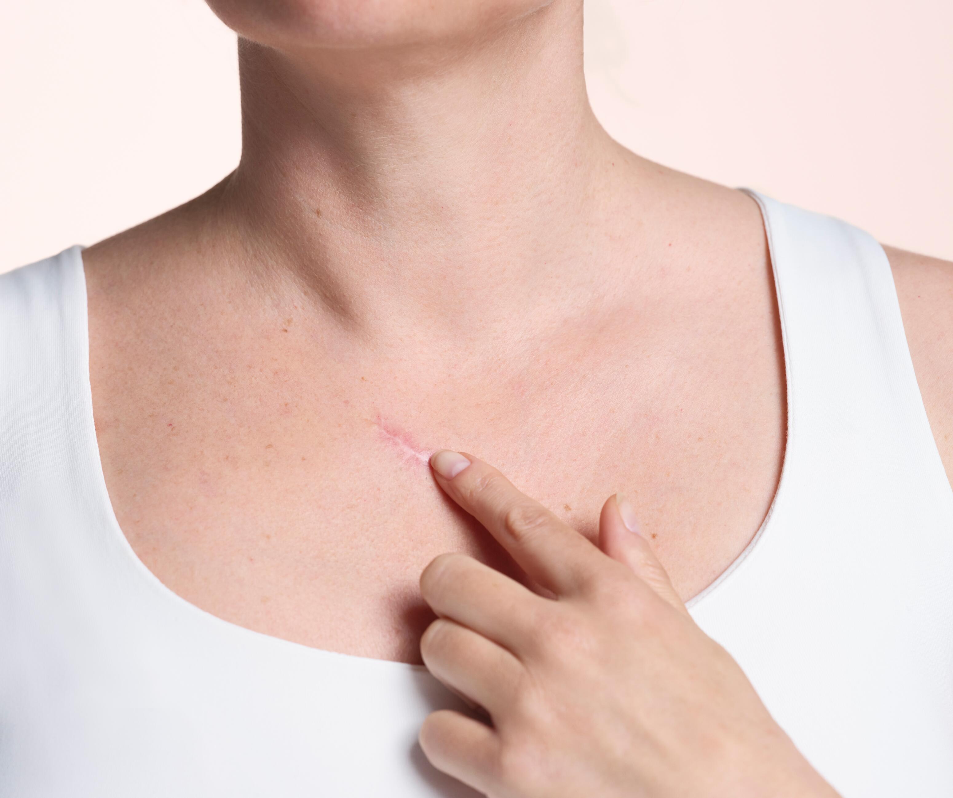 <p>Cicatrice semi-mature : PALPER-ROULER<br>Pincez d&eacute;licatement la peau entre le pouce et l&rsquo;index en faisant rouler le pli vers le haut et dans le sens de la cicatrice, jusqu&rsquo;&agrave; p&eacute;n&eacute;tration du soin (5 minutes environ).</p>

