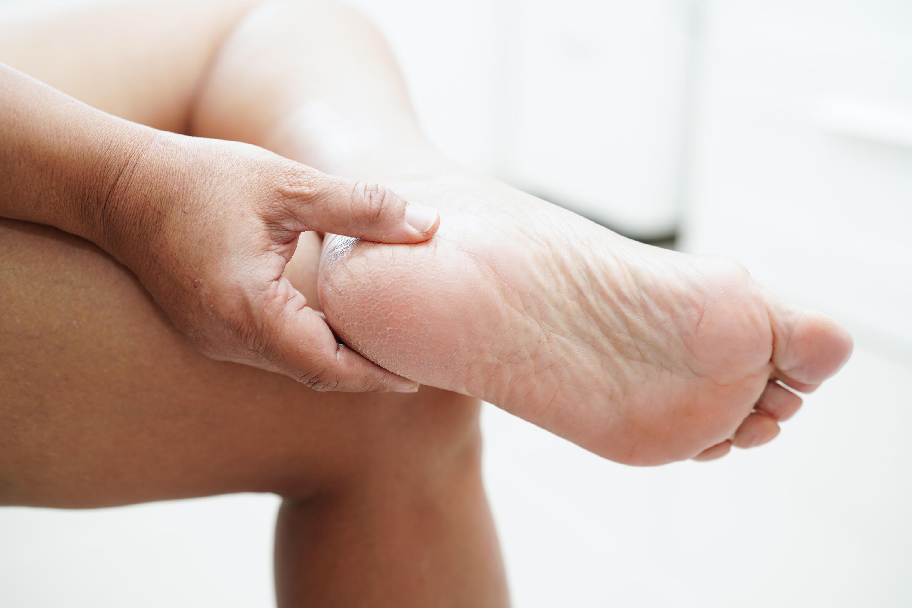 MD_DEXERYL_PF4MED_Pied-dabetique_AdobeStock_830632933