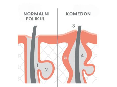 Što je koža sklona aknama?
