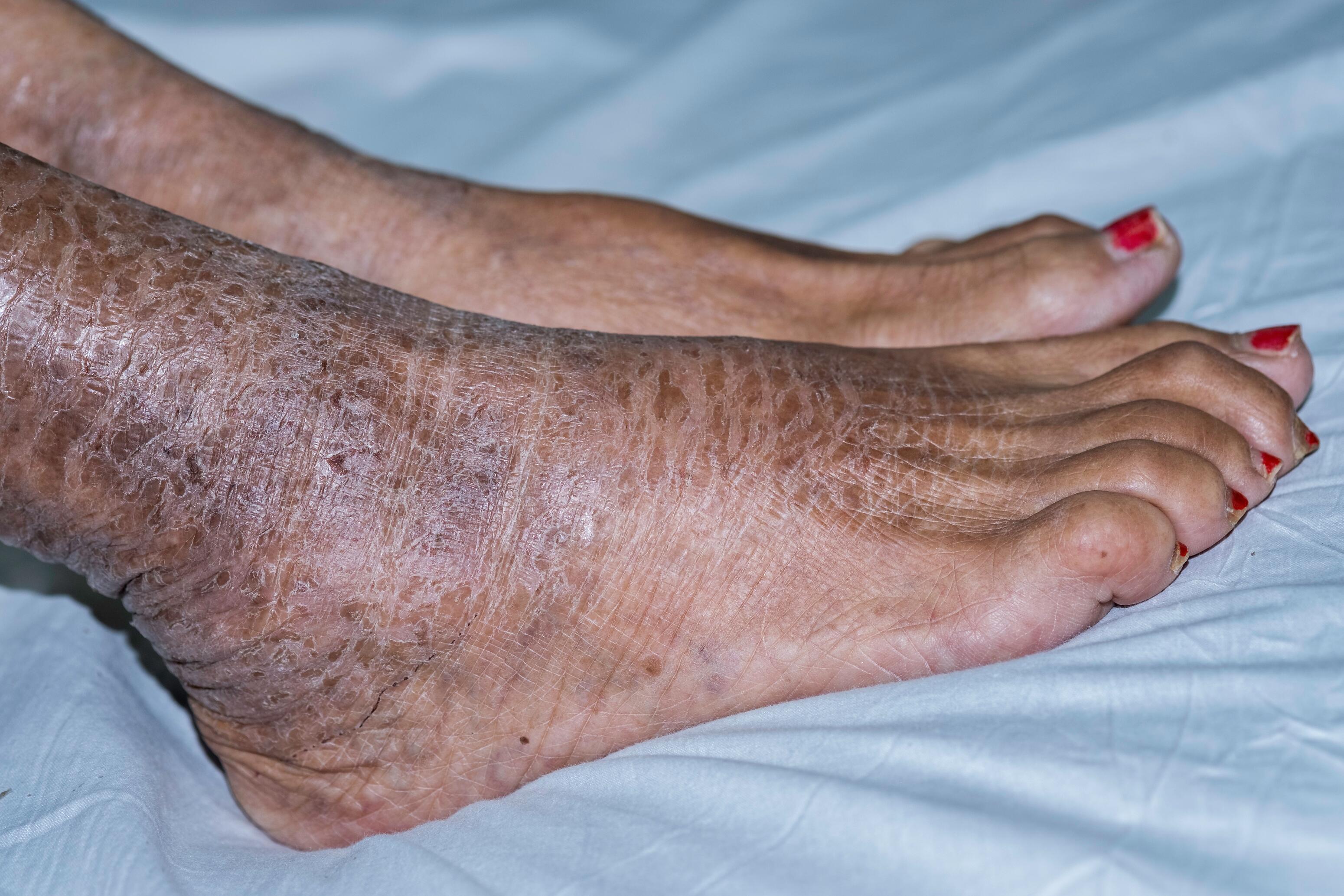 md_dexeryl_website-ichthyosis-image_adobestock_259958309