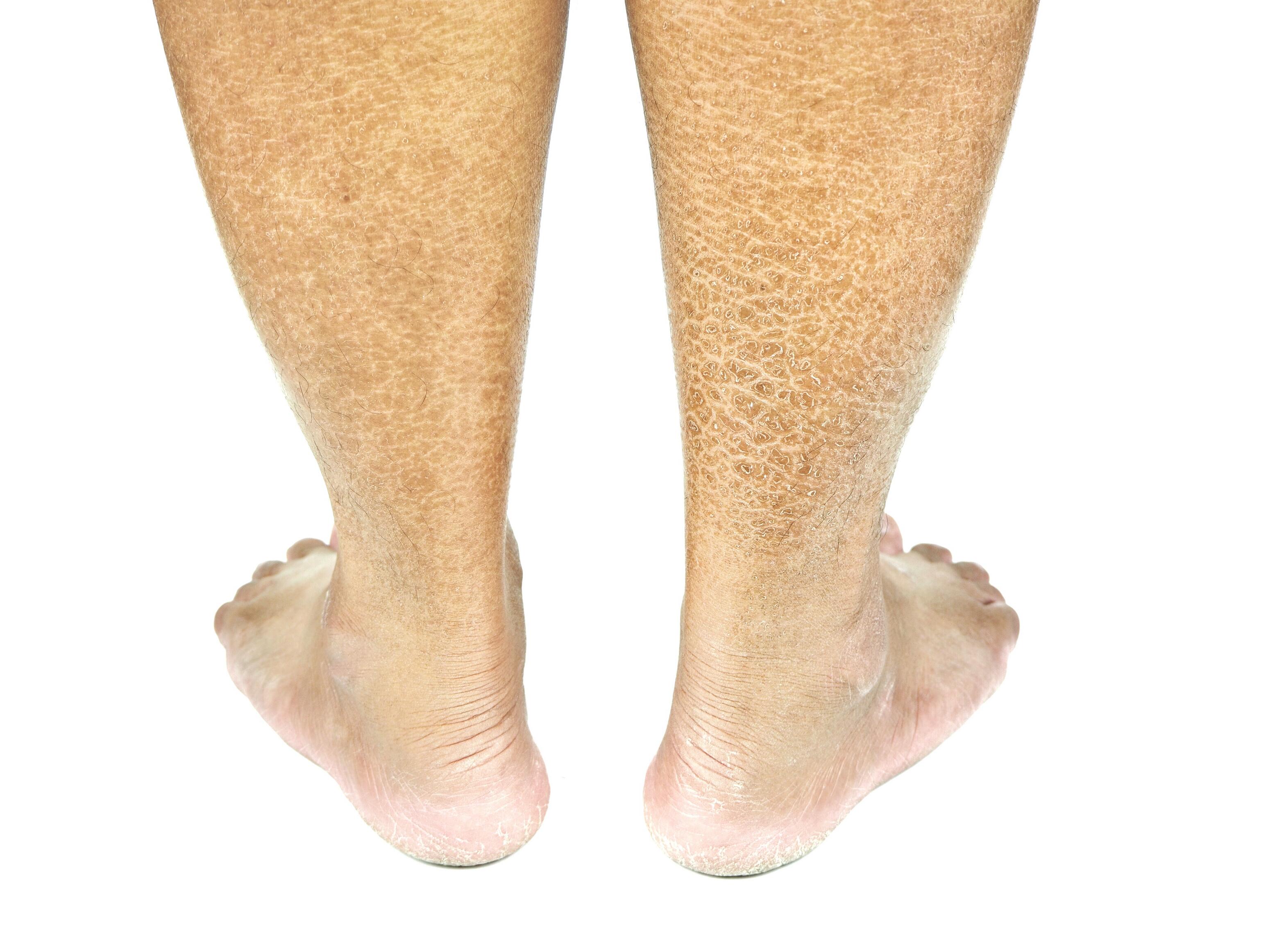 <p>Hyperkeratosis</p>

