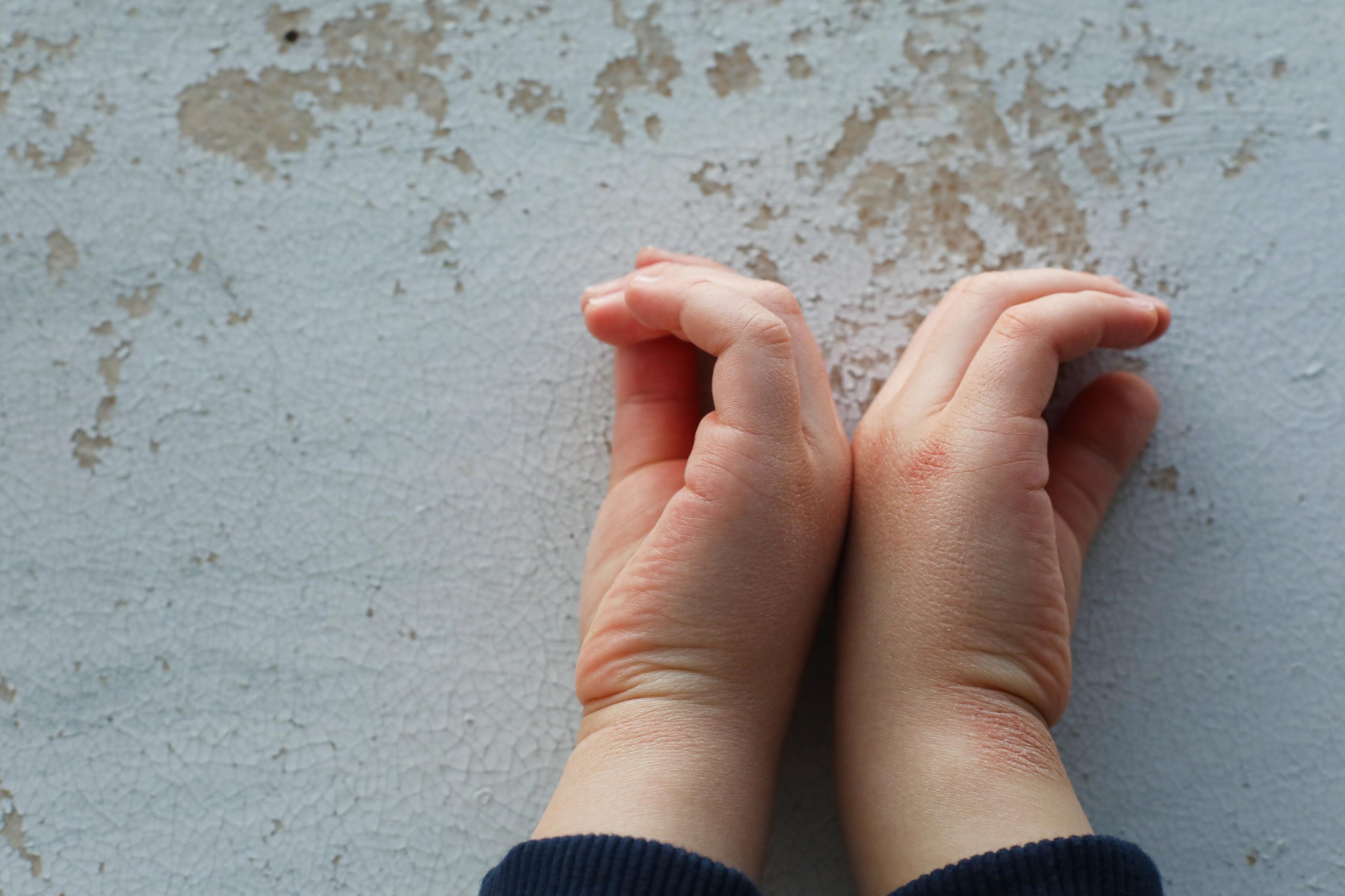 md_dexeryl_website-ichthyosis-image_adobestock_399477957